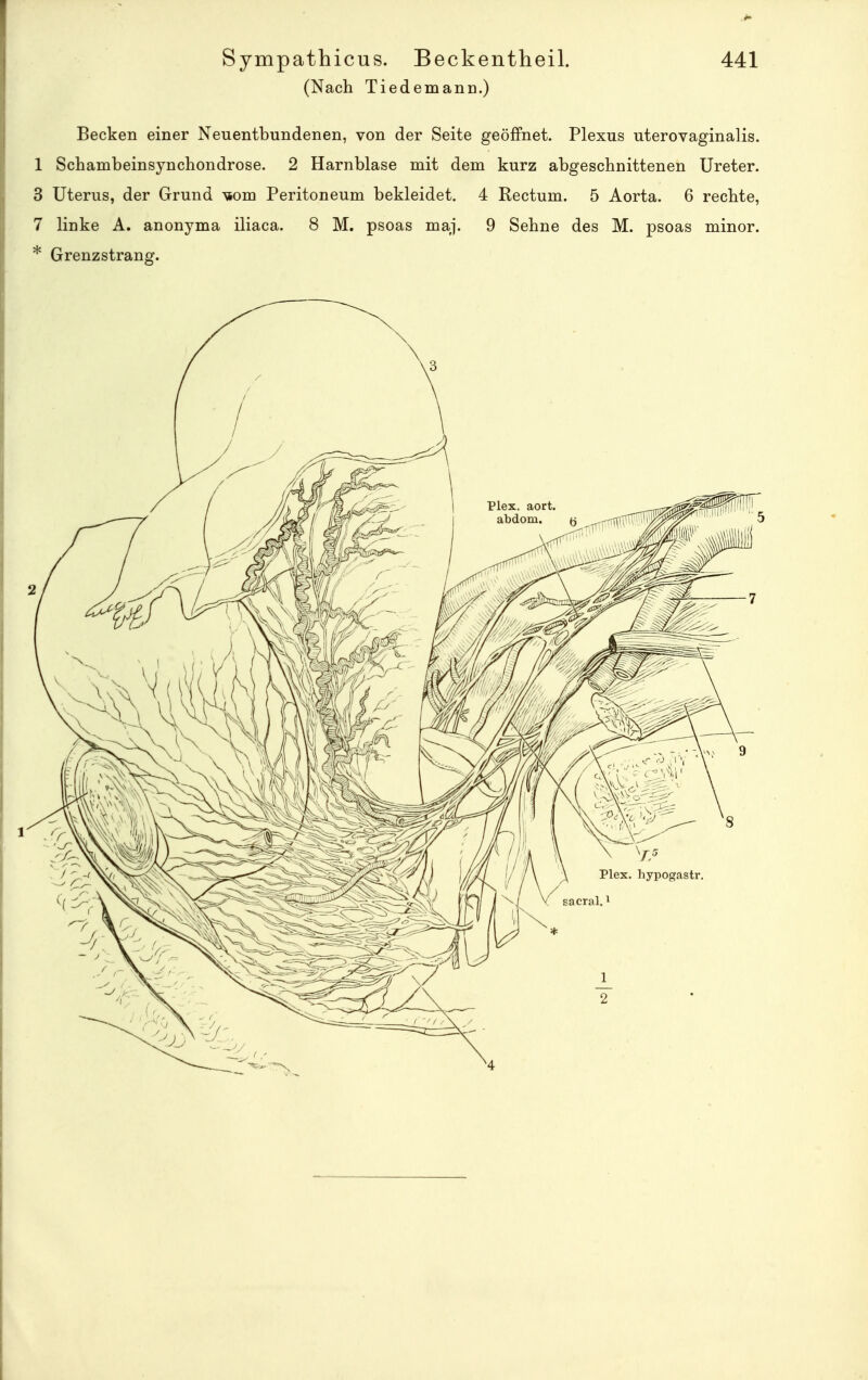 (Nach TiedemanD.) Becken einer Neuentbundenen, von der Seite geöffnet. Plexus uterovaginalis. 1 Schambeinsynchondrose. 2 Harnblase mit dem kurz abgeschnittenen Ureter. 3 Uterus, der Grund ^om Peritoneum bekleidet. 4 Rectum. 5 Aorta. 6 rechte, 7 linke A. anonyma iliaca. 8 M. psoas maj. 9 Sehne des M. psoas minor. * Grenzstrang.