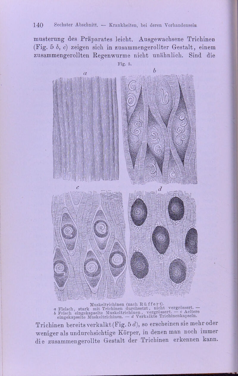 musterung des Präparates leicht. Ausgewachsene Trichinen (Fig. 5 b, c) zeigen sich in zusarmnengerollter Gestalt, einem zusammengerollten Regenwürme nicht unähnlich. Sind die Fig. 5. b Muskeltriclnnen (nach. R ü f f e r t). n Fleisch., stark mit Trichinen durchsetzt, nicht vergrossert. b Frisch eingekapselte Muskeltrichinen, vergrossert. c Aeltere eingekapselte Muskeltrichinen. — d Verkalkte Tnchmenkapseln. Trichinen bereits verkalkt (Fig. 5 d), so erscheinen sie mehr oder weniger als undurchsichtige Körper, in denen man noch immer die zusammengerollte Gestalt der Trichinen erkennen kann.