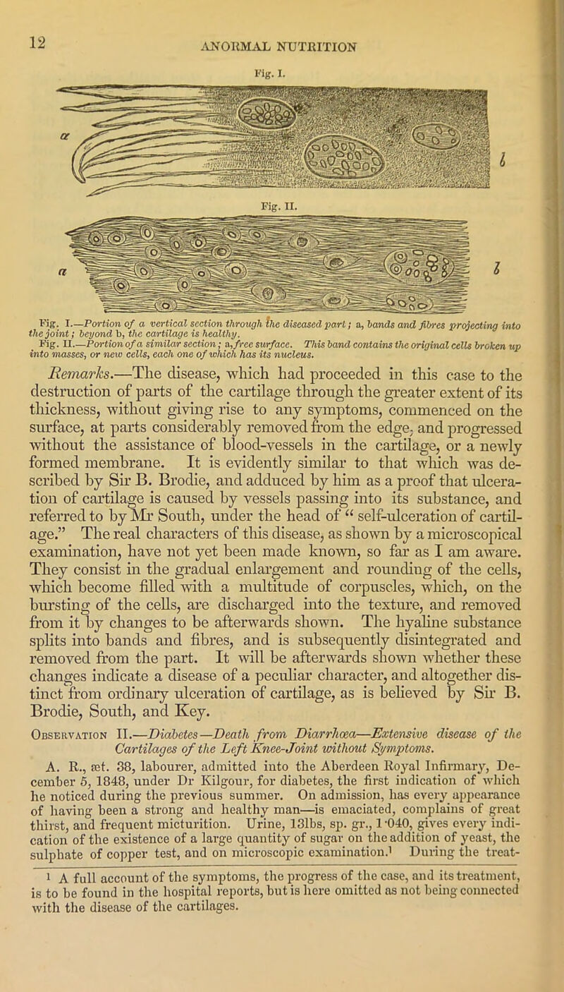 Fig. I. Fig. I—Portion of a vertical section through Ihc diseased part; a, hands and fibres project ing into the joint; beyond b, the cartilage is healthy. Fig. II .—Portion of a similar section; a, free surface. This band contains the original cells broken up into masses, or neui cells, each one of which has its nucleus. Remarks.—The disease, which had proceeded in this case to the destruction of parts of the cartilage through the greater extent of its thickness, without giving rise to any symptoms, commenced on the surface, at parts considerably removed from the edge, and progressed without the assistance of blood-vessels in the cartilage, or a newly formed membrane. It is evidently similar to that which was de- scribed by Sir B. Brodie, and adduced by him as a proof that ulcera- tion of cartilage is caused by vessels passing into its substance, and referred to by Mr South, under the head of “ self-ulceration of cartil- age.” The real characters of this disease, as shown by a microscopical examination, have not yet been made known, so far as I am aware. They consist in the gradual enlargement and rounding of the cells, which become filled with a multitude of corpuscles, which, on the bursting of the cells, are discharged into the texture, and removed from it by changes to be afterwards shown. The hyaline substance splits into bands and fibres, and is subsequently disintegrated and removed from the part. It will be afterwards shown whether these changes indicate a disease of a peculiar character, and altogether dis- tinct from ordinary ulceration of cartilage, as is believed by Sir B. Brodie, South, and Key. Observation II.—Diabetes—Death from. Diarrhoea—Extensive disease of the Cartilages of the Left Knee-Joint without Symptoms. A. R., let. 38, labourer, admitted into the Aberdeen Royal Infirmary, De- cember 5, 1848, under Dr Kilgour, for diabetes, the first indication of which he noticed during the previous summer. On admission, has every appearance of having been a strong and healthy man—is emaciated, complains of great thirst, and frequent micturition. Urine, 131bs, sp. gr., l-040, gives every indi- cation of the existence of a large quantity of sugar on the addition of yeast, the sulphate of copper test, and on microscopic examination.1 During the treat- 1 A full account of the symptoms, the progress of the case, and its treatment, is to be found in the hospital reports, but is here omitted as not being connected with the disease of the cartilages.