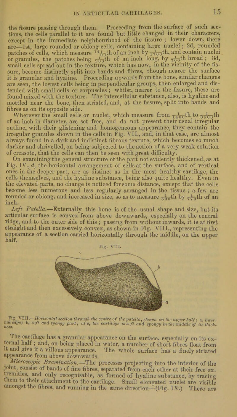 the fissure passing through them. Proceeding from the surface of such sec- tions, the cells parallel to it are found but little changed in their characters, except in the immediate neighbourhood of the fissure ; lower down, there are—1st, large rounded or oblong cells, containing large nuclei ; 2d, rounded patches of cells, which measure 14<hyth of an inch by -p^nyth, and contain nuclei or granules, the patches being tdi of an inch long, by 7-J-gth broad ; 3d, small cells spread out in the texture, which has now, in the vicinity of the fis- sure, become distinctly split into bands and fibres, though nearer the surface it is granular and hyaline. Proceeding upwards from the bone, similar changes are seen, the lowest cells being in perpendicular groups, then enlarged and dis- tended with small cells or corpuscles ; whilst, nearer to the fissure, these are found mixed with the texture. The intercellular substance, also, is hyaline and mottled near the bone, then striated, and, at the fissure, split into bands and fibres as on its opposite side. Wherever the small cells or nuclei, which measure from xiVo^1 1° of an inch in diameter, are set free, and do not present their usual irregular outline, with their glistening and homogeneous appearance, they contain the irregular granules shown in the cells in Fig. VII., and, in that case, are almost always found in a dark and indistinct fibrous texture, which becomes so much darker and shrivelled, on being subjected to the action of a very weak solution of creasote, that the cells can then be seen with great difficulty. On examining the general structure of the part not evidently thickened, as at Fig. IV., cl, the horizontal arrangement of cells at the surface, and of vertical ones in the deeper part, are as distinct as in the most healthy cartilage, the cells themselves, and the hyaline substance, being also quite healthy. Even in the elevated parts, no change is noticed for some distance, except that the cells become less numerous and less regularly arranged in the tissue ; a few are rounded or oblong, and increased in size, so as to measure -5pyoth by yl-jjth of an inch. Left Patella.—Externally this bone is of the usual shape and size, but its articular surface is convex from above downwards, especially on the central ridge, and to the outer side of this ; passing from without inwards, it is at first straight and then excessively convex, as shown in Fig. VIII., representing the appearance of a section carried horizontally through the middle, on the upper half. Fig. VIII. VIII—Horizontal section through the centre of the patella, shoivn on the. upper half; n, inter- ness6' b’ S°“ andsponM part ’ otc> thc cartilage is soft and spongy in the middle of its thick- The cartilage has a granular appearance on the surface, especially on its ex- ternal half; and, on being placed in water, a number of short fibres float from it and give it a villous appearance. The whole surface has a finely striated appearance from above downwards. . Microscopic Examination.—The processes projecting into the interior of the joint, consist of bands of fine fibres, separated from each other at their free ex- tremities, and only recognisable, as formed of hyaline substance, by tracing lem to their attachment to the cartilage. Small elongated nuclei are visible amongst the fibres, and running in the same direction—(Fig. IX.) There are