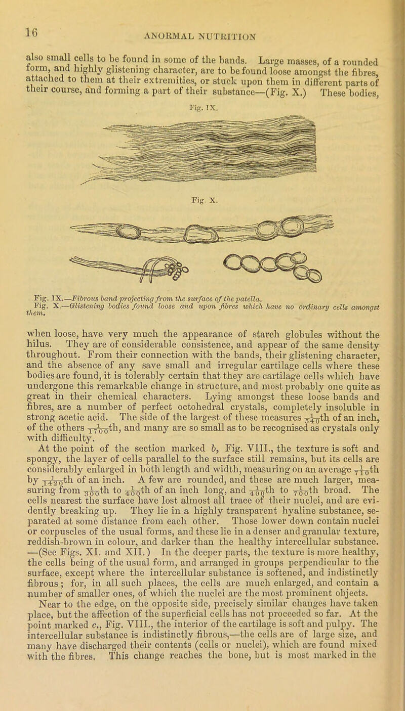 AWORMAL NUTRITION also small cells to be found in some of the bands. Large masses, of a rounded a’ld hlfhly glistening character, are to be found loose amongst the fibres, attached to them at their extremities, or stuck upon them in different parts of their course, and forming a part of their substance—(Fig. X.) These bodies, Hg. IX. Fig x. Fig. IX—Fibrous band projecting from the surface of the patella. Fig. X.—Glistening bodies found loose and upon fibres which have no ordinary cells amonast them. when loose, have very much the appearance of starch globules without the liilus. They are of considerable consistence, and appear of the same density throughout. From their connection with the bands, their glistening character, and the absence of any save small and irregular cartilage cells where these bodies are found, it is tolerably certain that they are cartilage cells which have undergone this remarkable change in structure, and most probably one quite as great in their chemical characters. Lying amongst these loose bands and fibres, are a number of perfect octohedral crystals, completely insoluble in strong acetic acid. The side of the largest of these measures ^^jth of an inch, of the others -iVooth, and many are so small as to be recognised as crystals only with difficulty. At the point of the section marked b, Fig. VIII., the texture is soft and spongy, the layer of cells parallel to the surface still remains, but its cells are considerably enlarged in both length and width, measuring on an average 7x5th by 1-42 0tli of an inch. A few are rounded, and these are much larger, mea- suring from ^jjTfth to 455th of an inch long, and 455th to 755th broad. The cells nearest the surface have lost almost all trace of their nuclei, and are evi- dently breaking up. They lie in a highly transparent hyaline substance, se- parated at some distance from each other. Those lower down contain nuclei or corpuscles of the usual forms, and these lie in a denser and granular texture, reddish-brown in colour, and darker than the healthy intercellular substance. —(See Figs. XI. and XII.) In the deeper parts, the texture is more healthy, the cells being of the usual form, and arranged in groups perpendicular to the surface, except where the intercellular substance is softened, and indistinctly fibrous; for, in all such places, the cells are much enlarged, and contain a number of smaller ones, of which the nuclei are the most prominent objects. Near to the edge, on the opposite side, precisely similar changes have taken place, but the affection of the superficial cells has not proceeded so far. At the point marked c., Fig. VIII., the interior of the cartilage is soft and pulpy. The intercellular substance is indistinctly fibrous,—the cells are of large size, and many have discharged their contents (cells or nuclei), which are found mixed with the fibres. This change reaches the bone, but is most marked in the