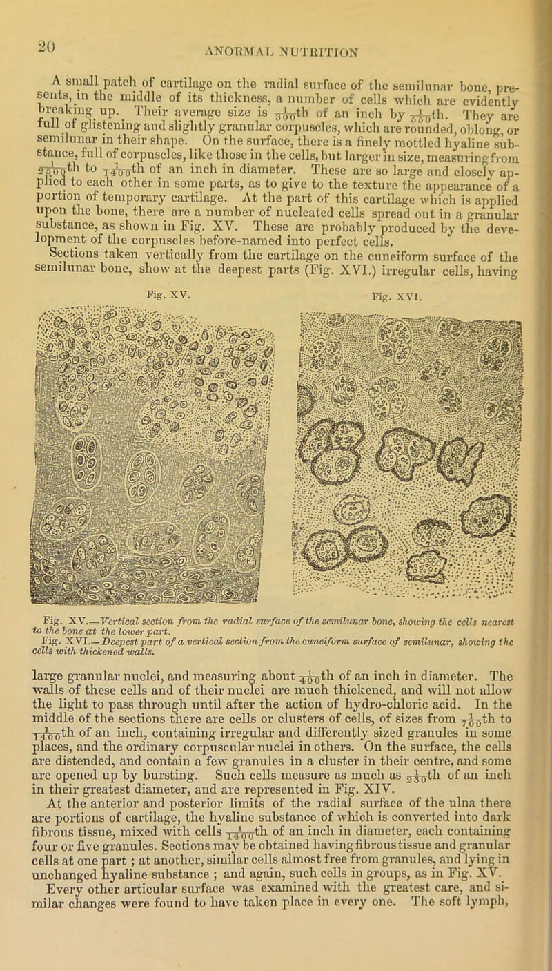 A small patch of cartilage on the radial surface of the semilunar bone, pre- sents, in the middle of its thickness, a number of cells which are evidently breaking up. Their average size is ^th of an inch by *foth. They are lull ol glistening and slightly granular corpuscles, which are rounded, oblong, or semilunar in their shape. On the surface, there is a finely mottled hyaline sub- stance, full of corpuscles, like those in the cells, but larger in size, measuring from 5TToTith to T4Voth of an inch in diameter. These are so large and closely ap- plied to each other in some parts, as to give to the texture the appearance of a portion of temporary cartilage. At the part of this cartilage which is applied upon the bone, there are a number of nucleated cells spread out in a granular substance, as shown in Fig. XV. These are probably produced by the deve- lopment of the corpuscles before-named into perfect cells. Sections taken vertically from the cartilage on the cuneiform surface of the semilunar bone, show at the deepest parts (Fig. XVI.) irregular cells, having Fig- XV. Fig. XVI. Fig. XV.—Vertical section from the radial surface of the semilunar hone, showing the cells nearest to the hone at the lower part. Fig. XVI.— Deepest part of a vertical section from the cuneiform surface of semilunar, showing the cells with thickened walls. large granular nuclei, and measuring about 4tyoth of an inch in diameter. The walls of these cells and of their nuclei are much thickened, and will not allow the light to pass through until after the action of hydro-chloric acid. In the middle of the sections there are cells or clusters of cells, of sizes from y^th to 14100th of an inch, containing irregular and different^ sized granules in some places, and the ordinary corpuscular nuclei in others. On the surface, the cells are distended, and contain a few granules in a cluster in their centre, and some are opened up by bursting. Such cells measure as much as 2 ^T)th of an inch in their greatest diameter, and are represented in Fig. XIV. At the anterior and posterior limits of the radial surface of the ulna there are portions of cartilage, the hyaline substance of which is converted into dark fibrous tissue, mixed with cells TJfroth of an inch in diameter, each containing four or five granules. Sections may be obtained having fibrous tissue and granular cells at one part; at another, similar cells almost free from granules, and lying in unchanged hyaline substance ; and again, such cells in groups, as in Fig. XV. Every other articular surface was examined with the greatest care, and si- milar changes were found to have taken place in every one. The soft lymph,