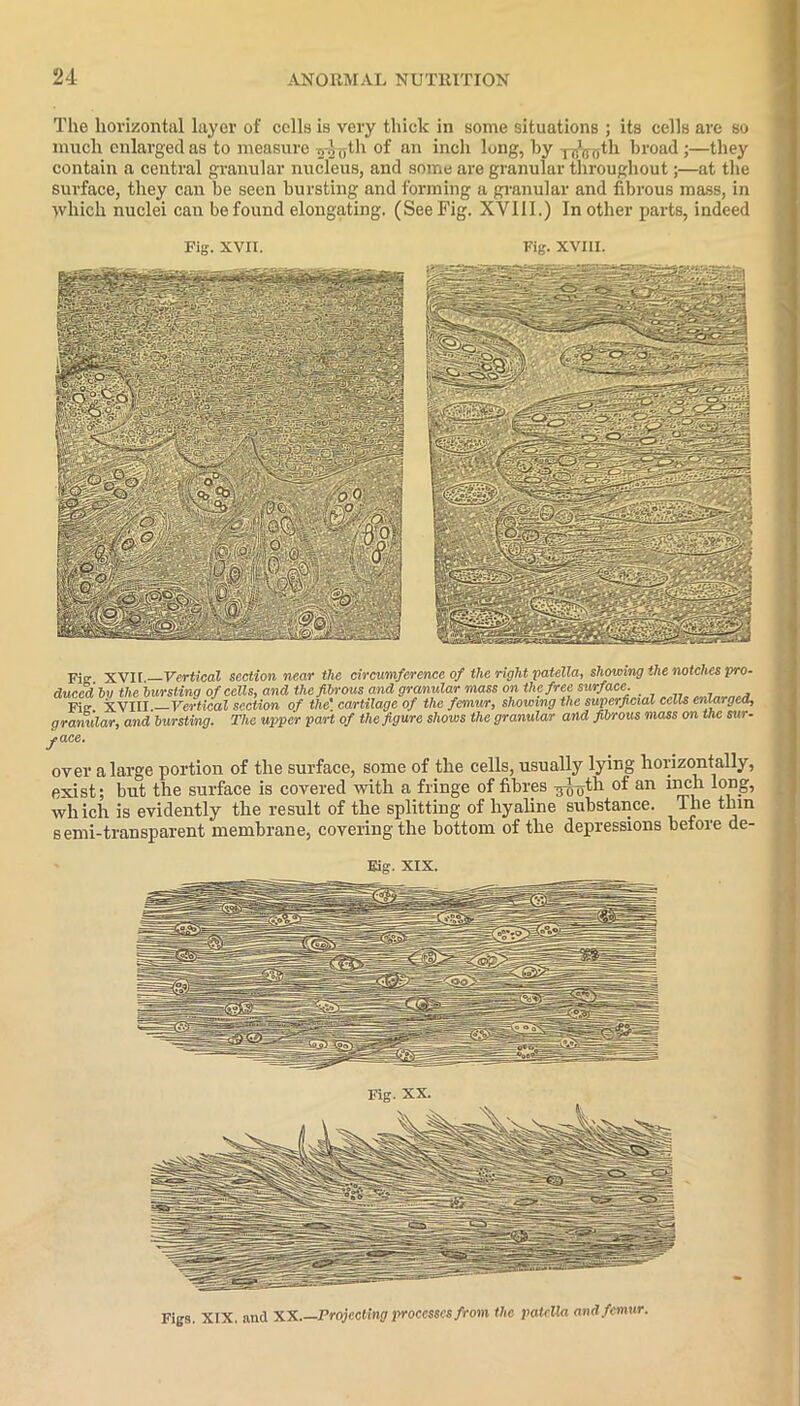 The horizontal layer of cells is very thick in some situations ; its cells are so much enlarged as to measure n-igtli of an inch long, by -p^th broad ;—they contain a central granular nucleus, and some are granular throughout;—at the surface, they can be seen bursting and forming a granular and fibrous mass, in which nuclei can be found elongating. (See Fig. XVIII.) In other parts, indeed Fig. XVII. Fig. XVIII. Fig. XVII.- -Vertical section near the circumference of the right patella, showing the notches pro- duced by the bursting of cells, and the fibrous and granular mass on the free surface. _ . . Fi XVIII. Vertical section of the' cartilage of the femur, showing the superficial cells enlarged, granular, and bursting. The upper part of the figure shows the granular and fibrous mass on the sur- face. over a large portion of the surface, some of the cells, usually lying horizontally, exist; but the surface is covered with a fringe of fibres ^jth of an inch long, which is evidently the result of the splitting of hyaline substance, llie thm semi-transparent membrane, covering the bottom of the depressions before de- Eig. XIX. Fig. XX. Figs. XIX. and XX.—Projecting processes from the patella and femur.