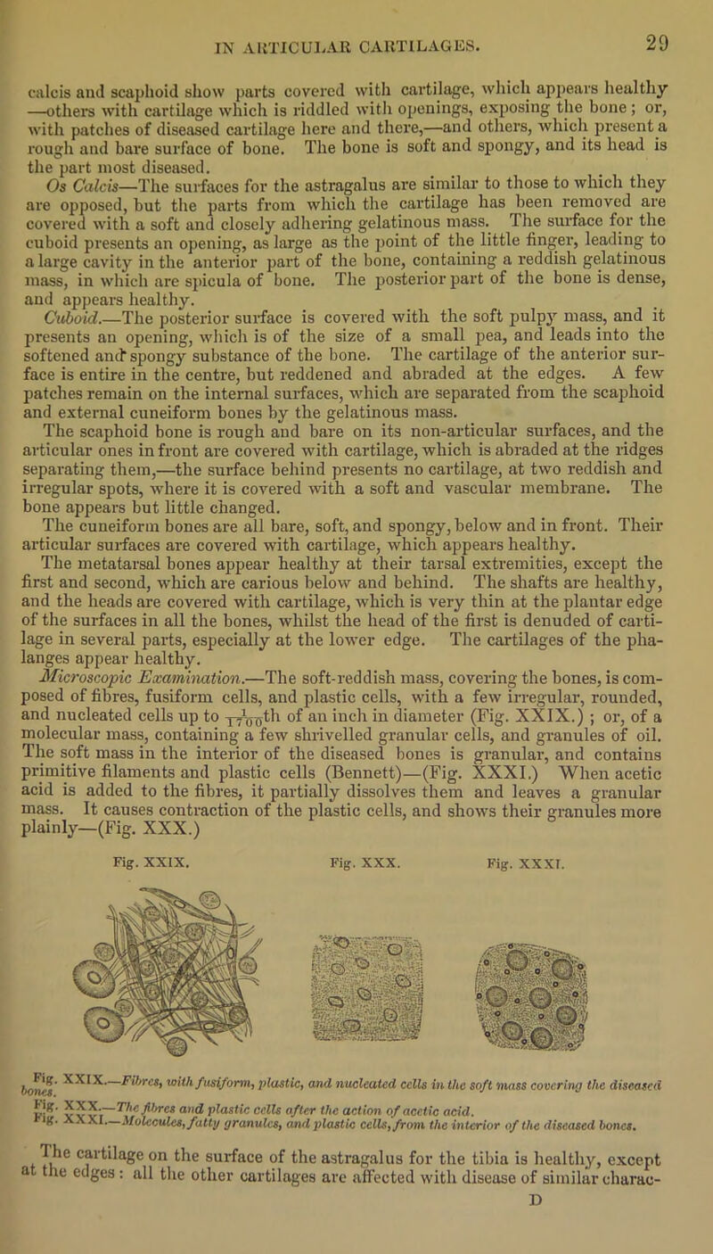calcis and scaphoid show parts covered with cartilage, which appears healthy —other’s with cartilage which is riddled with openings, exposing the bone; or, with patches of diseased cartilage here and there,—and others, which present a rough and bare surface of bone. The bone is soft and spongy, and its head is the part most diseased. Os Calcis—The surfaces for the astragalus are similar to those to which they are opposed, but the parts from which the cartilage has been removed are covered with a soft and closely adhering gelatinous mass. The surface for the cuboid presents an opening, as large as the point of the little finger, leading to a large cavity in the anterior part of the bone, containing a reddish gedatinous mass, in which are spicula of bone. The posterior part of the bone is dense, and appears healthy. Cuboid.—The posterior surface is covered with the soft pulpy mass, and it presents an opening, which is of the size of a small pea, and leads into the softened and’spongy substance of the bone. The cartilage of the anterior sur- face is entire in the centre, but reddened and abraded at the edges. A few patches remain on the internal surfaces, which are separated from the scaphoid and external cuneiform bones by the gelatinous mass. The scaphoid bone is rough and bare on its non-articular surfaces, and the articular ones in front are covered with cartilage, which is abraded at the ridges separating them,—the surface behind presents no cartilage, at two reddish and irregular spots, where it is covered with a soft and vascular membrane. The bone appears but little changed. The cuneiform bones are all bare, soft, and spongy, below and in front. Their articular surfaces are covered with cartilage, which appears healthy. The metatarsal bones appear healthy at their tarsal extremities, except the first and second, which are carious below and behind. The shafts are healthy, and the heads are covered with cartilage, which is very thin at the plantar edge of the surfaces in all the bones, whilst the head of the first is denuded of carti- lage in several parts, especially at the lower edge. The cartilages of the pha- langes appear healthy. Microscopic Examination.—The soft-reddish mass, covering the bones, is com- posed of fibres, fusiform cells, and plastic cells, with a few irregular, rounded, and nucleated cells up to TT0T)th of an inch in diameter (Fig. XXIX.) ; or, of a molecular mass, containing a few shrivelled granular cells, and granules of oil. The soft mass in the interior of the diseased bones is granular, and contains primitive filaments and plastic cells (Bennett)—(Fig. XXXI.) When acetic acid is added to the fibres, it partially dissolves them and leaves a granular mass. It causes contraction of the plastic cells, and shows their granules more plainly—(Fig. XXX.) Fig. XXIX. Fig. XXX. Fig. XXXI. »w; —Fibres, with fusiform, plastic, and nucleated cells in the soft mass covering the diseased v v vi~ The fibres and plastic cells after the action of acetic acid. fg. XX XI—Molecules, fatty granules, and plastic cells, from the interior of the diseased bones. The cartilage on the surface of the astragalus for the tibia is healthy, except a the edges : all the other cartilages are affected with disease of similar charac- D