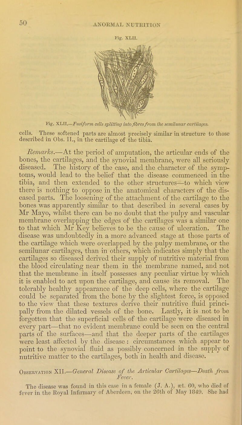 Fig. XLII. Fig. XLII.—Fusiform cells splitting into fibres from the semilunar cartilages. cells.. These softened parts are almost precisely similar in structure to those described in Obs. II., in the cartilage of the tibia. Remarks.—At the period of amputation, the articular ends of the bones, the cartilages, and the synovial membrane, were all seriously diseased. The history of the case, and the character of the symp- toms, would lead to the belief that the disease commenced in the tibia, and then extended to the other structures—to which view there is nothing to oppose in the anatomical characters of the dis- eased parts. The loosening of the attachment of the cartilage to the hones was apparently similar to that described in several cases by Mr Mayo, whilst there can be no doubt that the pulpy and vascular membrane overlapping the edges of the cartilages was a similar one to that which Mi’ Key believes to be the cause of ulceration. The disease was undoubtedly in a more advanced stage at those parts of the cartilage which were overlapped by the pulpy membrane, or the semilunar cartilages, than in others, which indicates simply that the cartilages so diseased derived their supply of nutritive material from the blood circulating near them in the membrane named, and not that the membrane in itself possesses any peculiar virtue by which it is enabled to act upon the cartilage, and cause its removal. The tolerably healthy appearance of the deep cells, where the cartilage could be separated from the hone by the slightest force, is opposed to the view that these textures derive their nutritive fluid princi- pally from the dilated vessels of the bone. Lastly, it is not to he forgotten that the superficial cells of the cartilage were diseased in every part—that no evident membrane could be seen on the central parts of the surfaces—and that the deeper parts of the cartilages were least affected by the disease : circumstances which appear to point to the synovial fluid as possibly concerned in the supply of nutritive matter to the cartilages, both in health and disease. Observation XII.—General Disease of the Articular Cartilages—Death from Fever. The disease was found in this case in a female (J. A.), ret. 60, who died of fever in the Royal Infirmary of Aberdeen, on the 2Gth of May 1049. She had