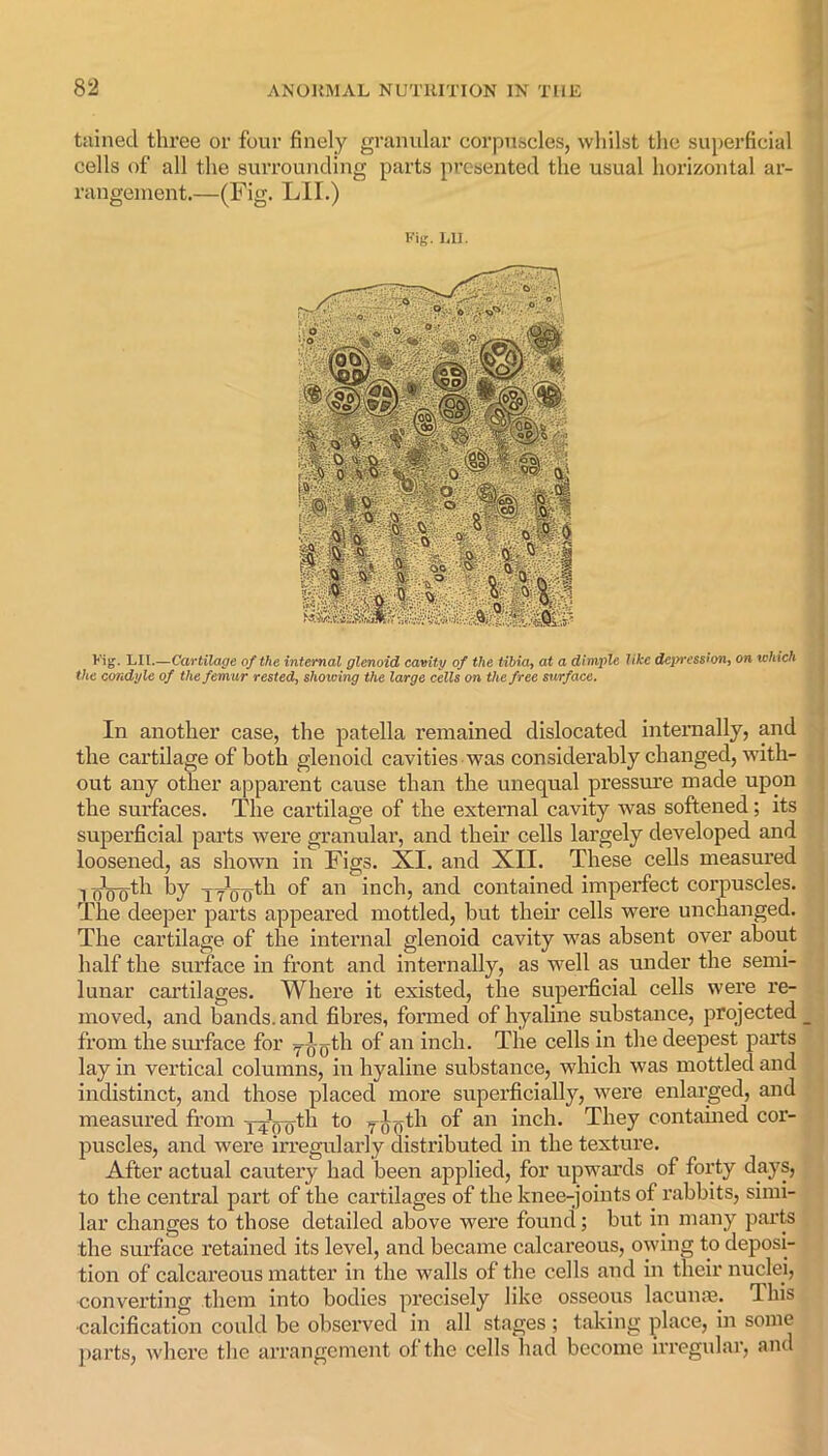 tained three or four finely granular corpuscles, whilst the superficial cells of all the surrounding parts presented the usual horizontal ar- rangement.—(Fig. LII.) Fig. LII. Fig. LII.—Cartilage of the internal glenoid cavity of the tibia, at a dimple like depression, on which the condyle of the femur rested, showing the large cells on the free surface. In another case, the patella remained dislocated internally, and the cartilage of both glenoid cavities was considerably changed, with- out any other apparent cause than the unequal pressure made upon the surfaces. The cartilage of the external cavity was softened; its superficial parts were granular, and their cells largely developed and loosened, as shown in Figs. XI. and XII. These cells measured 11)() Qth by -jYoffth of an inch, and contained imperfect corpuscles. The deeper parts appeared mottled, but then’ cells were unchanged. The cartilage of the internal glenoid cavity was absent over about half the surface in front and internally, as well as under the semi- lunar cartilages. Where it existed, the superficial cells were re- moved, and bands, and fibres, formed of hyaline substance, projected _ from the siu’face for y^th of an inch. The cells in the deepest parts lay in vertical columns, in hyaline substance, which was mottled and indistinct, and those placed more superficially, were enlarged, and measured from yJ(T(jth to y-((?jth of an inch. They contained cor- puscles, and were irregularly distributed in the texture. After actual cautery had been applied, for upwards of forty days, to the central part of the cartilages of the knee-joints of rabbits, simi- lar changes to those detailed above were found; but in many parts the surface retained its level, and became calcareous, owing to deposi- tion of calcareous matter in the walls of the cells and in their nuclei, converting them into bodies precisely like osseous lacuna?. I his ■calcification could be observed in all stages ; taking place, in some parts, where the arrangement of the cells had become irregular, and