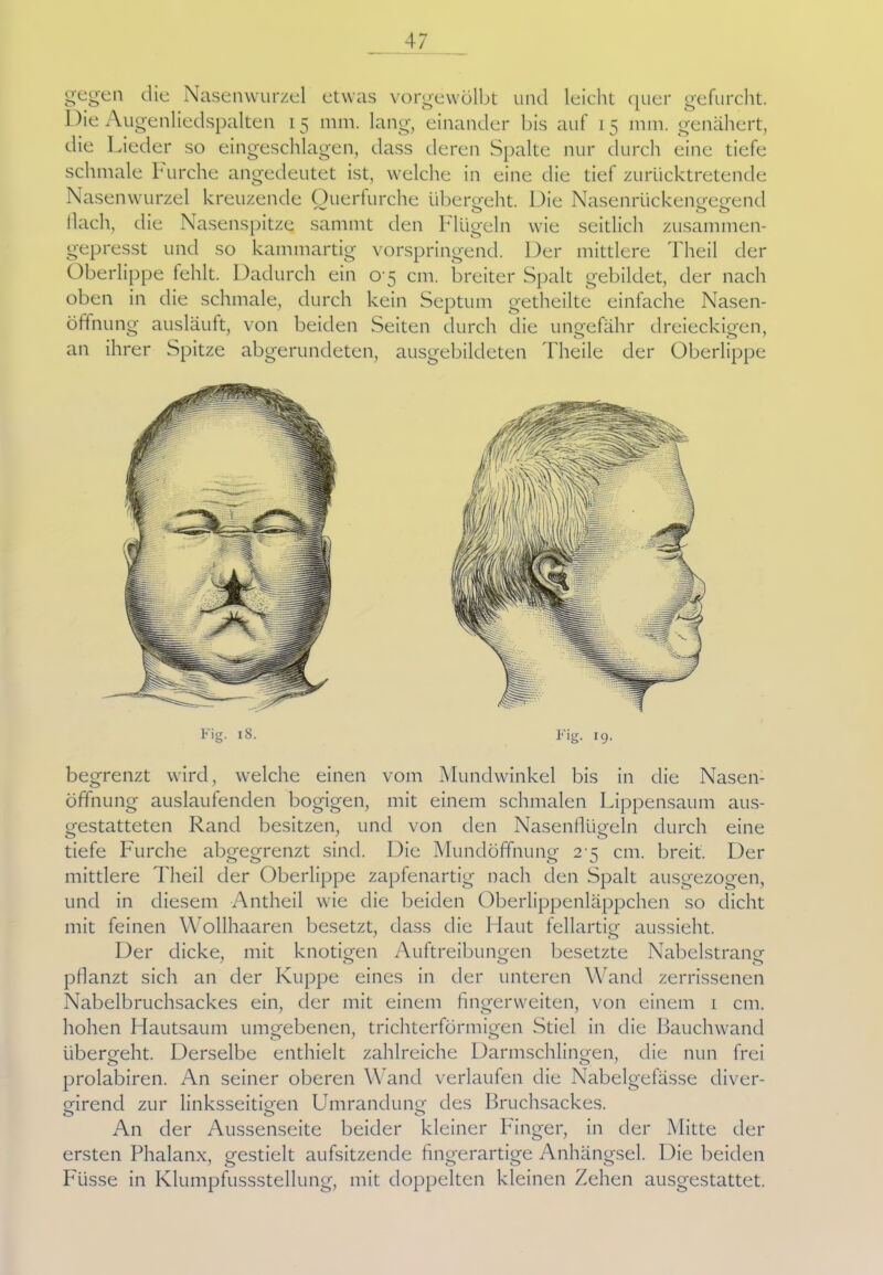 gegen die Nasenwurzel etwas vorgewölbt und leicht quer gefurcht. Die Augenliedspalten 15 mm. lang, einander bis auf 15 mm. genähert, die Lieder so eingeschlagen, dass deren Spalte nur durch eine tiefe schmale Furche angedeutet ist, welche in eine die tief zurücktretende Nasenwurzel kreuzende Querfurche übergeht. Die Nasenrückengegend Hach, die Nasenspitze sammt den Flügeln wie seitlich zusammen- gepresst und so kammartig vorspringend. Der mittlere Theil der Oberlippe fehlt. Dadurch ein 0 5 cm. breiter Spalt gebildet, der nach oben in die schmale, durch kein Septum getheilte einfache Nasen- öffnung ausläuft, von beiden Seiten durch die ungefähr dreieckigen, an ihrer Spitze abgerundeten, ausgebildeten Theile der Oberlippe begrenzt wird, welche einen vom Mundwinkel bis in die Nasen- öffnung auslaufenden bogigen, mit einem schmalen Lippensaum aus- gestatteten Rand besitzen, und von den Nasenflügeln durch eine tiefe Furche abgegrenzt sind. Die Mundöffnung 2^5 cm. breit. Der mittlere Theil der Oberlippe zapfenartig nach den Spalt ausgezogen, und in diesem Antheil wie die beiden Oberlippenläppchen so dicht mit feinen Wollhaaren besetzt, dass die Haut fellartig aussieht. Der dicke, mit knotigen Auftreibungen besetzte Nabelstrang pflanzt sich an der Kuppe eines in der unteren Wand zerrissenen Nabelbruchsackes ein, der mit einem fingerweiten, von einem 1 cm. hohen Hautsaum umgebenen, trichterförmigen Stiel in die Bauchwand übergeht. Derselbe enthielt zahlreiche Darmschlingen, die nun frei prolabiren. An seiner oberen Wand verlaufen die Nabelgefässe diver- girend zur linksseitigen Umrandung des Bruchsackes. An der Aussenseite beider kleiner Finger, in der Mitte der ersten Phalanx, gestielt aufsitzende fingerartige Anhängsel. Die beiden Fiisse in Klumpfussstellung, mit doppelten kleinen Zehen ausgestattet.