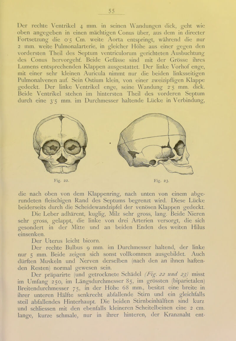 DD Der rechte Ventrikel 4 mm. in seinen Wandungen dick, geht wie oben angegeben in einen mächtigen Conus über, aus dem in directer Fortsetzung' die 0 5 Cm. weite Aorta entspringt, während die nur 2 mm. weite Pulmonalarterie, in gleicher Höhe aus einer gegen den vordersten Theil des Septum ventriculorum gerichteten Ausbuchtung des Conus hervorgeht. Beide Gefässe sind mit der Grösse ihres Lumens entsprechenden Klappen ausgestattet. Der linke Vorhof enge, mit einer sehr kleinen Auricula nimmt nur die beiden linksseitigen Pulmonalvenen auf. Sein Ostium klein, von einer zweizipfligen Klappe gedeckt. Der linke Ventrikel enge, seine Wandung 2 5 mm. dick. Beide Ventrikel stehen im hintersten Theil des vorderen Septum durch eine 3-5 mm. im Durchmesser haltende Lücke in Verbindung, Fig. 22. Fie. 2 die nach oben von dem Klappenring, nach unten von einem abge- rundeten fleischigen Rand des Septums begrenzt wird. Diese Lücke beiderseits durch die Scheidewandzipfel der venösen Klappen gedeckt. Die Leber adhärent, kuglig, Milz sehr gross, lang. Beide Nieren sehr gross, gelappt, die linke von drei Arterien versorgt, die sich gesondert in der Mitte und an beiden Enden des weiten Hilus o einsenken. Der Uterus leicht bicorn. Der rechte Bulbus 9 mm. im Durchmesser haltend, der linke nur 5 mm. Beide zeigen sich sonst vollkommen ausgebildet. Auch dürften Muskeln und Nerven derselben (nach den an ihnen haften- den Resten) normal gewesen sein. Der präparirte (und getrocknete Schädel (Fig. 22 und 23) misst im Umfang 250, im Längsdurchmesser 85, im grössten (biparietalen) Breitendurchmesser 75, in der Höhe 68 mm., besitzt eine breite in ihrer unteren Hälfte senkrecht abfallende Stirn und ein gleichfalls steil abfallendes Hinterhaupt. Die beiden Stirnbeinhälften sind kurz und schliessen mit den ebenfalls kleineren Scheitelbeinen eine 2 cm. lange, kurze schmale, nur in ihrer hinteren, der Kranznaht ent-