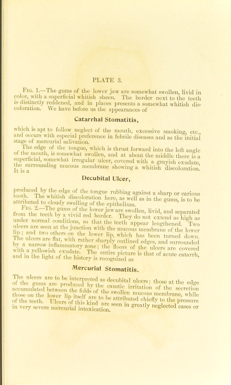 Fig. 1. The gums of the lower jaw are somewhat swollen, livid in color, with a superficial whitish sheen. The border next to the teeth is distinctly reddened, and in places presents a somewhat whitish dis- coloration. \\ e have before us the appearances of Catarrhal Stomatitis,  hich is apt to follow neglect ol the mouth, excessive smoking, etc. and occurs with especial preference in febrile diseases and as the initial stage ot mercurial salivation. The edge of the tongue, which is thrust forward into the left angle of the mouth, is somewhat swollen, and at about the middle there is a superficial, somewhat irregular ulcer, covered with a grayish exudate hesurrounding mucous membrane showing a whitish discoloration! JLL IS u. Decubital Ulcer, foothUCeThbe^!bfiiefger°f ‘ihe t'-ngllf rubbinS against a sharp or carious tooth. The whitish discoloration here, as well as in the gums, is to be attributed to cloudy swelling of the epithelium. ’ 1 ig. 2.—The gums of the lower jaw are swoilen, livid, and separated from the teeth by a vivid red border. They do not extend as high as under normal conditions, so that the teeth appear lengthened. Two Hn anTtwToS JUn,f°V witbt.he “neons membrane of the lower bp, and two others on the lower lip, which has been turned down The ulcers are flat, with rather sharply outlined edges, and surrounded ; the floors of the ulcers are covered n lin hJSofdVi The 6ntire pictUre is that of acute catariE ami in the light of the history is recognized as Mercurial Stomatitis. c,ecftal •> «*** accumulated between the folds of the swoll ntatlon secretion those on the lower lip itseKre to hetT^«memhmn0> while Of the teeth. Ulcers of this kinV ’wl. , -), G< c ,efly to the Pressure