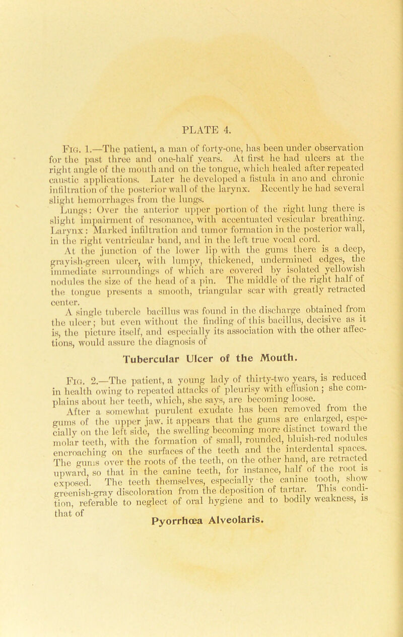 Fig. 1.—The patient, a man of forty-one, has been under observation for the past three and one-half years. At first he had ulcers at the right angle of the mouth and on the tongue, which healed after repeated caustic applications. Later he developed a fistula in ano and chronic infiltration of the posterior wall of the larynx. Recently he had several slight hemorrhages from the lungs. Lungs: Over the anterior upper portion of the right lung there is slight impairment of resonance, with accentuated vesicular breathing. Larynx: Marked infiltration and tumor formation in the posterior wall, in the right ventricular hand, and in the left true vocal cord. _ At the junction of the lower lip with the gums there is a deep, grayish-green ulcer, with lumpy, thickened, undermined edges, the immediate surroundings of which are covered by isolated yellowish nodules the size of the head of a pin. The middle, of the right half of the tongue presents a smooth, triangular scar with greatly retracted center. , . A single tubercle bacillus was found in the discharge obtained from the ulcer; but even without the finding of this bacillus, decisive as it is, the picture itself, and especially its association with the other affec- tions, would assure the diagnosis of Tubercular Ulcer of the Mouth. Fro. 2.—The patient, a young lady of thirty-two years, is reduced in health owing to repeated attacks of pleurisy with effusion; she com- plains about her teeth, which, she says, are becoming loose. After a somewhat purulent exudate has been removed from the gums of the upper jaw. it appears that the gums are enlarged, espe- cially on the left side, flic swelling becoming more distinct toward the molar teeth, with the formation of small, rounded, bluish-red nodules encroaching on the surfaces of the teeth and the interdental spaces. The gums over the roots of the teeth, on the other hand, arc retracted upward, so that in the canine teeth, for instance, half of the root is exposed. The teeth themselves, especially the canine tooth, show greenish-gray discoloration from the deposition of tartar I his condi- tion, referable to neglect of oral hygiene and to bodily weakness, is that of , ,, , . Pyorrhoea Alveolans.
