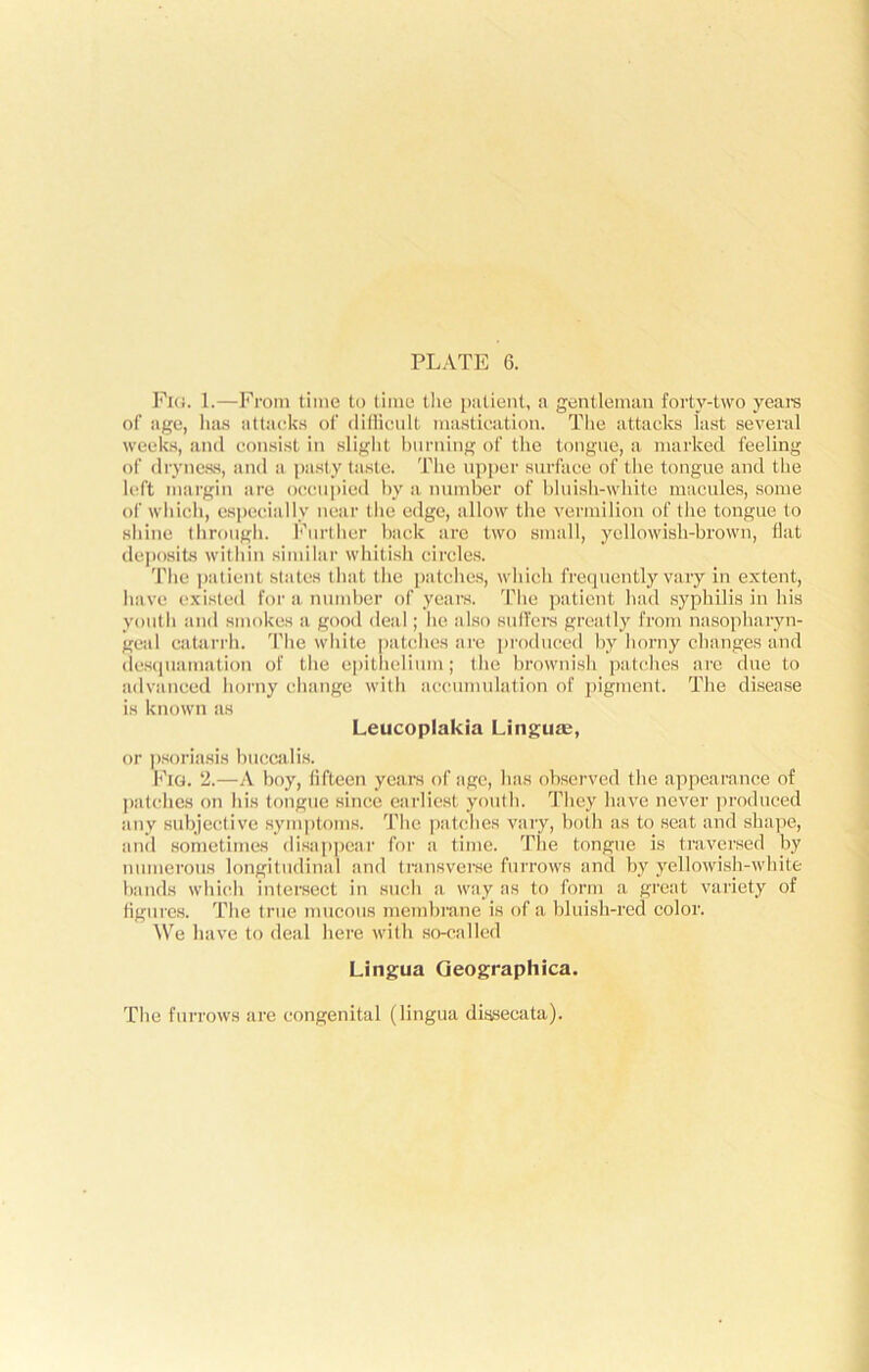 Fig. 1.—From time to time the patient, a gentleman forty-two years of age, has attacks of difficult mastication. The attacks last several weeks, and consist in slight burning of the tongue, a marked feeling of dryness, and a pasty taste. The upper surface of the tongue and the left margin are occupied by a number of bluish-white macules, some of which, especially near the edge, allow the vermilion of the tongue to shine through. Further back are two small, yellowish-brown, flat deposits within similar whitish circles. The patient states that the patches, which frequently vary in extent, have exisleil for a number of years. The patient had syphilis in his youth and smokes a good deal; he also suffers greatly from nasopharyn- geal catarrh. The white patches are produced by horny changes and desquamation of the epithelium; the brownish patches are due to advanced horny change with accumulation of pigment. The disease is known as Leucoplakia Linguas, or psoriasis buccalis. Fig. 2.—A boy, fifteen years of age, has observed the appearance of patches on his tongue since earliest youth. They have never produced any subjective symptoms. The patches vary, both as to seat and shape, and sometimes disappear for a time. The tongue is traversed by numerous longitudinal and transverse furrows and by yellowish-white bands which intersect in such a way as to form a great variety of figures. The true mucous membrane is of a bluish-red color. We have to deal here with so-called Lingua Geographica. The furrows are congenital (lingua dissecata).