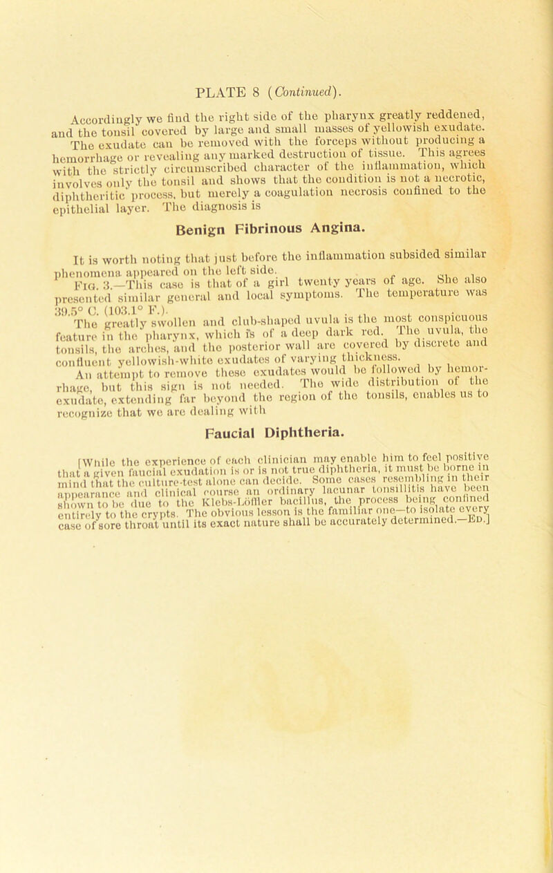 PLATE 8 (Continued). Accordingly we find the right side of the pharynx greatly reddened, and the tonsil covered by large and small masses of yellowish exudate. The exudate can be removed with the forceps without producing a hemorrhage or revealing any marked destruction of tissue. This agrees with the strictly circumscribed character of the inflammation, which involves only the tonsil and shows that the condition is not a necrotic, diphtheritic process, but merely a coagulation necrosis confined to the epithelial layer. The diagnosis is Benign Fibrinous Angina. It is worth noting that just before the inflammation subsided similai phenomena appeared on the left side. „ , Fui 3 —This case is that of a girl twenty years of age. She also presented similar general and local symptoms. The temperature was 39 5° C (103.1° F.). The greatly swollen and club-shaped uvula is the conspicuous feature in the pharynx, which fs of a deep dark red. The uvula, the tonsils, the arches, and the posterior wall are covered by discrete and confluent yellowish-white exudates of varying thickness. An attempt to remove those exudates would be followed by hemor- rhage, hut this sign is not needed. The wide distribution of the exudate, extending far beyond the region of the tonsils, enables us to recognize that we are dealing with Faucial Diphtheria. (While the experience of each clinician may enable him to feel positive that a given faucial exudation is or is not true diphtheria, it must be borne in mind that the culture-test alone can decide. Some cases resembling in their appearance and clinical course an ordinary lacunar tonsillitis have been X wn to be due to the KlobH-Lofller bacillus, the process being confined entirely to the crypts. The obvious lesson is the familiar one—to isolate every caseonjore throat until its exact nature shall be accurately determined.-En.]