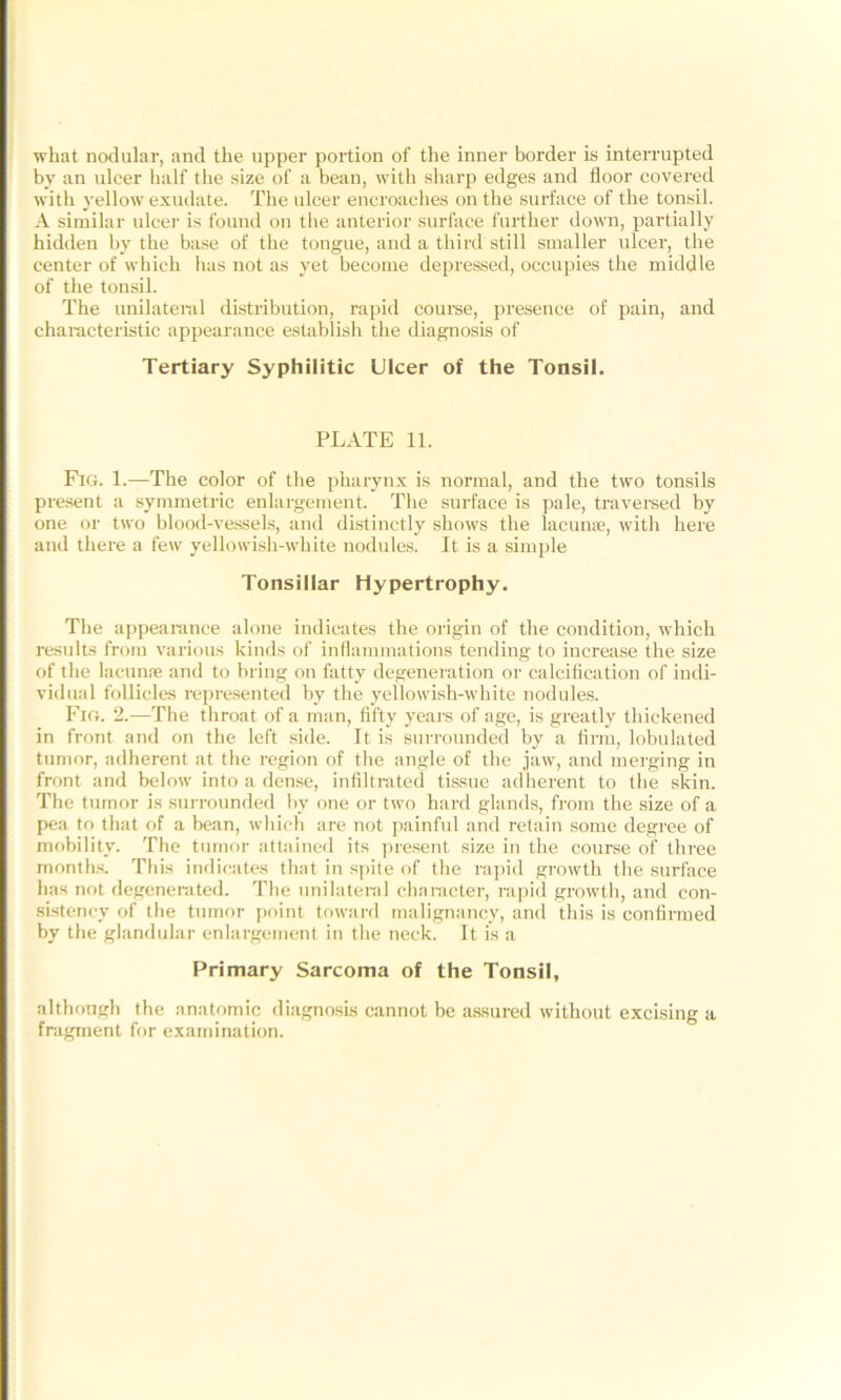 what nodular, and the upper portion of the inner border is interrupted by an ulcer half the size of a bean, with sharp edges and floor covered with yellow exudate. The ulcer encroaches on the surface of the tonsil. A similar ulcer is found on the anterior surface further down, partially hidden by the base of the tongue, and a third still smaller ulcer, the center of which has not as yet become depressed, occupies the middle of the tonsil. The unilateral distribution, rapid course, presence of pain, and characteristic appearance establish the diagnosis of Tertiary Syphilitic Ulcer of the Tonsil. PLATE 11. Fig. 1.—The color of the pharynx is normal, and the two tonsils present a symmetric enlargement. The surface is pale, traversed by one or two blood-vessels, and distinctly shows the lacunae, with here and there a few yellowish-white nodules. It is a simple Tonsillar Hypertrophy. The appearance alone indicates the origin of the condition, which results from various kinds of inflammations tending to increase the size of the lacunae and to bring on fatty degeneration or calcification of indi- vidual follicles represented by the yellowish-white nodules. Fig. 2.—The throat of a man, fifty years of age, is greatly thickened in front and on the left side. It is surrounded by a firm, lobulated tumor, adherent at the region of the angle of the jaw, and merging in front and below into a dense, infiltrated tissue adherent to the skin. The tumor is surrounded by one or two hard glands, from the size of a pea to that of a bean, which arc not painful and retain some degree of mobility. The tumor attained its present size in the course of three months. This indicates that in spite of the rapid growth the surface has not degenerated. The unilateral character, rapid growth, and con- sistency of the tumor point toward malignancy, and this is confirmed by the glandular enlargement in the neck. It is a Primary Sarcoma of the Tonsil, although the anatomic diagnosis cannot be assured without excising a fragment for examination.