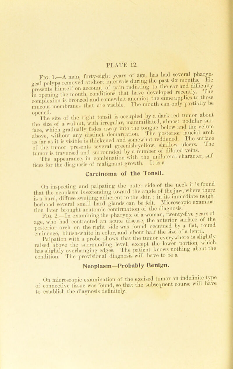 FjG l.—A man, forty-eight years of age, has had several pharyn- geal polyp8 removed at short intervals during the past six months. He presents himself on account of pain radiating to the ear and difficulty in opening the mouth, conditions that have developed recently. Ihe complexion is bronzed and somewhat anemic; the same applies to those mucous membranes that are visible, ihe mouth can only paitially he 0|’The site of the right tonsil is occupied by a dark-red tumor about the size of a walnut, with irregular, mammillated, almost nodular sui- face, which gradually fades away into the tongue below and the velum above, without any distinct demarcation, ihe posterior faucial such as far as it is visible is thickened and somewhat reddened. 1 he smface of the tumor presents several greenish-yellow, shallow ulceis. Ihe tumor is traversed and surrounded by a number of dilated veins. The appearance, in combination with the unilateral charactei, suf- fices for the diagnosis of malignant growth. It is a Carcinoma of the Tonsil. On inspecting and palpating the outer side of the neck it is found that the neoplasm is extending toward the angle of the jaw, where there is a hard, diffuse swelling adherent to the skin ; in its immediate neigh- borhood several small hard glands can be felt. Microscopic examina- tion later brought anatomic confirmation of the diagnosis. Fifi. 2.—In examining the pha rynx of a woman, twenty-five ycaisot age, who had contracted an acute disease, the anterior surface of the posterior arch on the right side was found occupied by a flat, round eminence, bluish-white in color, and about hall the size of a lentil. Palpation with a probe shows that the tumor everywhere is slightly raised above the surrounding level, except the lower portion, which has slightly overhanging edges. The patient knows nothing about the condition. The provisional diagnosis will have to be a Neoplasm—Probably Benign. On microscopic examination of the excised tumor an indefinite type of connective tissue was found, so that the subsequent course will have to establish the diagnosis definitely.