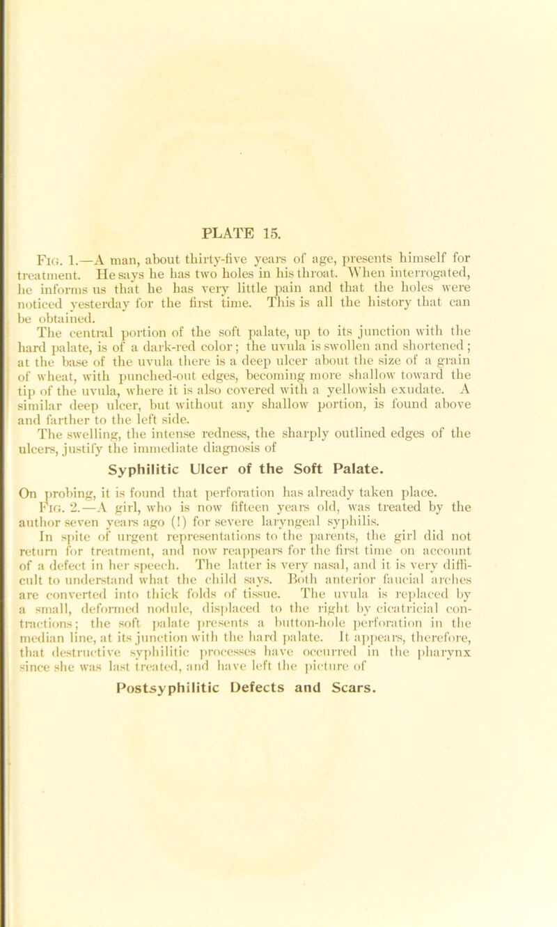 Fig. 1.—A man, about thirty-five years of age, presents himself for treatment. He says he has two holes in his throat. When interrogated, lie informs us that he has very little pain and that the holes were noticed yesterday for the first time. This is all the history that can be obtained. The central portion of the soft palate, up to its junction with the hard palate, is of a dark-red color; the uvula is swollen and shortened ; at the base of the uvula there is a deep ulcer about the size of a grain of wheat, with punched-out edges, becoming more shallow toward the tip of the uvula, where it is also covered with a yellowish exudate. A similar deep ulcer, but without any shallow portion, is found above and farther to the left side. The swelling, the intense redness, the sharply outlined edges of the ulcers, justify the immediate diagnosis of Syphilitic Ulcer of the Soft Palate. On probing, it is found that perforation has already taken place. Fig. 2.—A girl, who is now fifteen years old, was treated by the author seven years ago (!) for severe laryngeal syphilis. In spite of urgent representations to the parents, the girl did not return for treatment, and now reappears for the first time on account of a defect in her speech. The latter is very nasal, and it is very diffi- cult to understand what the child says. Both anterior faucial arches are converted into thick folds of tissue. The uvula is replaced by a small, deformed nodule, displaced to the right by cicatricial con- tractions; the soft palate presents a button-hole perforation in the median line, at its junction with the hard palate. It appears, therefore, that destructive syphilitic processes have occurred in the pharynx since she was last treated, and have left the picture of Postsyphilitic Defects and Scars.