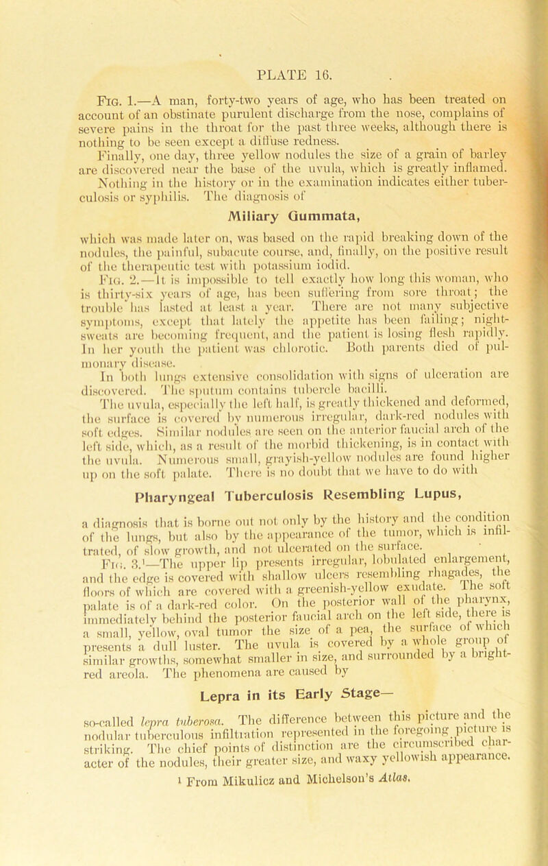 Fig. 1.—A man, forty-two years of age, who has been treated on account of an obstinate purulent discharge from the nose, complains of severe pains in the throat for the past three weeks, although there is nothing to he seen except a diffuse redness. Finally, one day, three yellow nodules the size of a grain of barley are discovered near the base of the uvula, which is greatly inflamed. Nothing in the history or in the examination indicates either tuber- culosis or syphilis. The diagnosis of Miliary Gummata, which was made later on, was based on the rapid breaking down of the nodules, the painful, subacute course, and, finally, on the positive result of the therapeutic test with potassium iodid. Fig. ‘2. — It is impossible to tell exactly how long this woman, who is thirty-six years of age, lias been suflering from sore throat ; the trouble lias lasted at least a year. There are not many subjective symptoms, except that lately the appetite lias been failing; night- sweats are becoming frequent, and the patient is losing flesh rapidly. In her youth the patient was chlorotic. Both parents died of pul- monary disease. In both lungs extensive consolidation with signs of ulceration are discovered. The sputum contains tubercle bacilli. The uvula, especially the left half, is greatly thickened and deformed, the surface is covered by numerous irregular, dark-red. nodules with soft edges. Similar nodules are seen on the anterior faucial arch of the left side, which, as a result of' the morbid thickening, is in contact.with the uvula. Numerous small, grayish-yellow nodules are found higher up on the soft palate. There is no doubt that we have to do with Pharyngeal Tuberculosis Resembling Lupus, a diagnosis that is borne out not only by the history and the condition of the lungs, but also by the appearance of the tumor, which is infil- trated, of slow growth, and not ulcerated on the surface. Fro 3 '—The upper lip presents irregular, lobulated enlargement, and the edge is covered with shallow ulcers resembling rhagades, the floors of which are covered with a greenish-yellow exudate, lhe solt palate is of a dark-red color. On the. posterior wall of the pharynx, immediately behind the posterior faucial arch on the left side, tlieie is a small, yellow, oval tumor the size of a pea, the surface of which presents a dull luster. The uvula is. covered by a whole group of similar growths, somewhat smaller in size, and surrounded by a biight- red areola. The phenomena are caused by Lepra in its Early Stage- so-called lepra tuberosa. The difference between this pit tun and the nodular tuberculous infiltration represented m the foregoing, pictuie is striking. The chief points of distinction are the circumscribed char- acter of the nodules, their greater size, and waxy yellowish appearance. 1 From Mikulicz and Miclielsou’s Atlas.