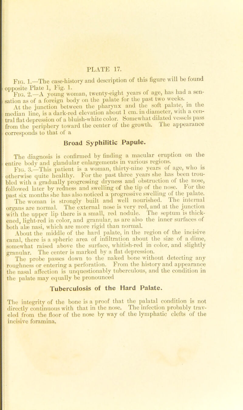 Fig. 1.—The case-history and description of this figure will be found opposite Plate 1, Fig. 1. „ , , , Fig. 2.—A young woman, twenty-eight years ol age, has had a sen- sation as of a foreign body on the palate for the past two weeks.. At the junction between the pharynx and the soft palate, in the median line, is a dark-red elevation about 1 cm. in diameter, with a cen- tral flat depression of a bluish-white color. Somewhat dilated vessels pass from the periphery toward the center of the growth, ihe appearance corresponds to that of a Broad Syphilitic Papule. The diagnosis is confirmed by finding a macular eruption on the entire body and glandular enlargements in various regions. Fig. 3.—This patient is a woman, thirty-nine years of age, who is otherwise quite healthy. For the past three years she. has been tiou- bled with a gradually progressing dryness and obstruction of the nose, followed later by redness and swelling of the tip of the nose. For the past six months she has also noticed a progressive swelling of the palate. The woman is strongly built and well nourished. The internal organs are normal. The external nose is very red, and at the junction with the upper lip there is a small, red nodule. The septum is thick- ened, light-red in color, and granular, as are also the inner surfaces of both al;e nasi, which are more rigid than normal. About the middle of the hard palate, in the region of the incisive canal, there is a spheric area of infiltration about the size of a dime, somewhat raised above the surface, whitish-red in color, and slightly granular. The center is marked by a flat depression. The probe passes down to the naked bone without detecting any roughness or entering a perforation. From the history and appearance the nasal affection is unquestionably tuberculous, and the condition in the palate may equally be pronounced Tuberculosis of the Hard Palate. The integrity of the bone is a proof that the palatal condition is not directly continuous with that in the nose. The infection probably trav- eled from the floor of the nose by way of the lymphatic clefts of the incisive foramina.