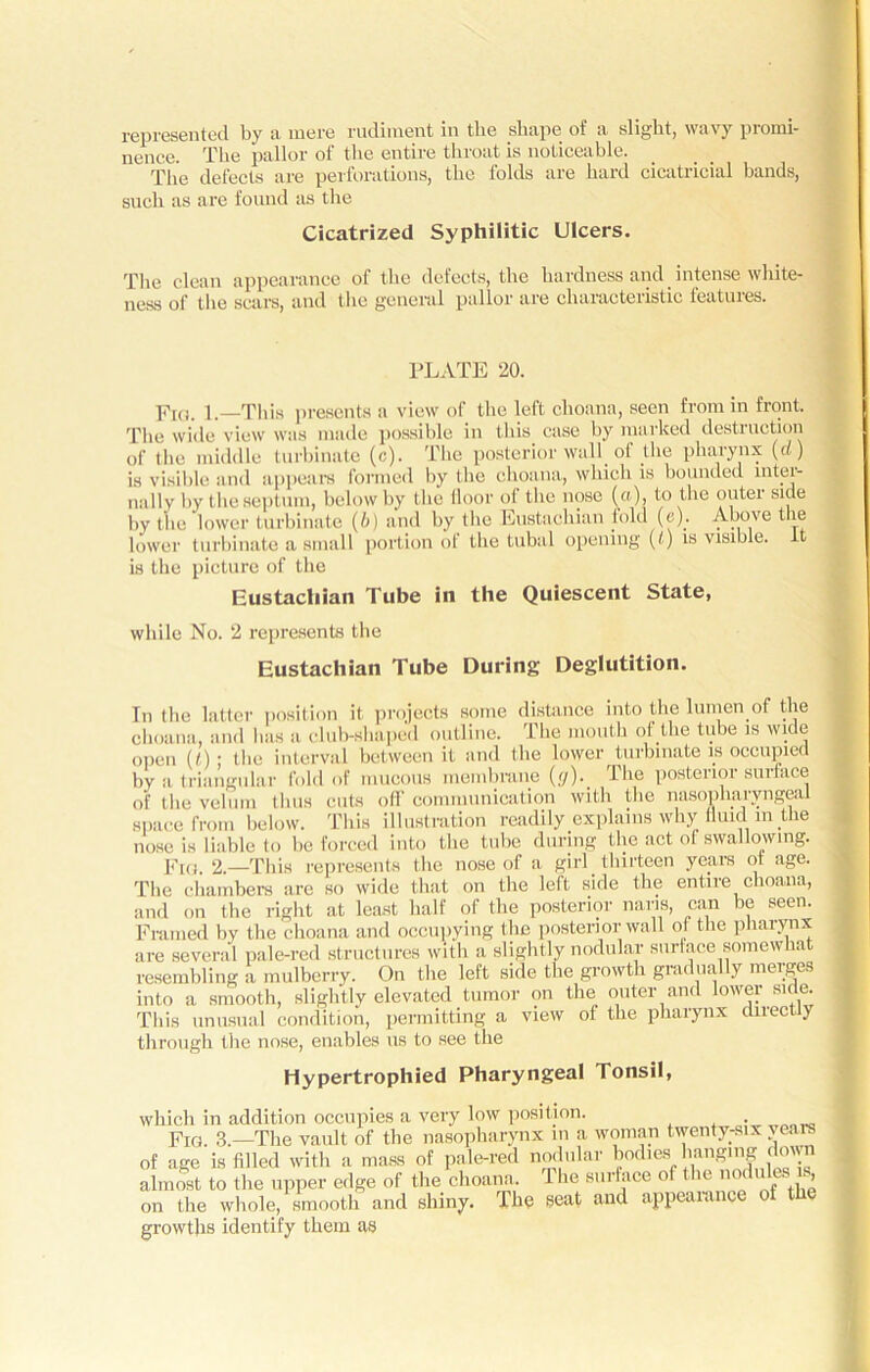 represented by a mere rudiment in the shape ot a slight, wavy pionn- nence. The pallor ot the entire tin oat is noticeable. ^ The defects are perforations, the folds are hard cicatricial bands, such as are found as the Cicatrized Syphilitic Ulcers. The clean appearance of the defects, the hardness and intense white- ness of the scars, and the general pallor are characteristic features. PLATE 20. Fig. l—This presents a view of the left choana, seen from in front. The wide view was made possible in this case by marked destruction of the middle turbinate (c). The posterior wall of the pharynx (d) is visible and appeal's formed by the choana, which is bounded mtei- nally by the septum, below by the floor oi the nose (a), to the outei side by the lower turbinate (b) and by the Eustachian told (e). Above the lower turbinate a small portion of the tubal opening (t) is visible, it is the picture of the Eustacliian Tube in the Quiescent State, while No. 2 represents the Eustachian Tube During Deglutition. In the latter position it projects some distance into the lumen of the choana, and has a club-shaped outline. The mouth of the tube is wide open (<); the interval between it and the lower turbinate is occupied by a triangular fold of mucous membrane (</)._ The posterior surface of the velum thus cuts off communication with the nasopharyngeal space from below. This illustration readily explains why fluid in the nose is liable to be forced into the tube during the act of swallowing. Fia. 2.—This represents the nose of a girl thirteen years ot age. The chambers are so wide that on the left side the entire choana, and on the right at least half of the posterior nans, can be seen. Framed by the choana and occupying the posterior wall of the pharynx are several pale-red structures with a slightly nodular surface somewhat resembling a mulberry. On the left side the growth gradually merges into a smooth, slightly elevated tumor on the outer and lower side. This unusual condition, permitting a view of the pharynx dnectiy through the nose, enables us to see the Hypertrophied Pharyngeal Tonsil, which in addition occupies a very low position. Fig. 3.—The vault of the nasopharynx in a woman twenty-six vears of age is filled with a mass of pale-red nodular bodies hanging down almost to t he upper edge of the choana 1 be surface of the nodules is on the whole, smooth and shiny. The seat and appearance of the growths identify them as