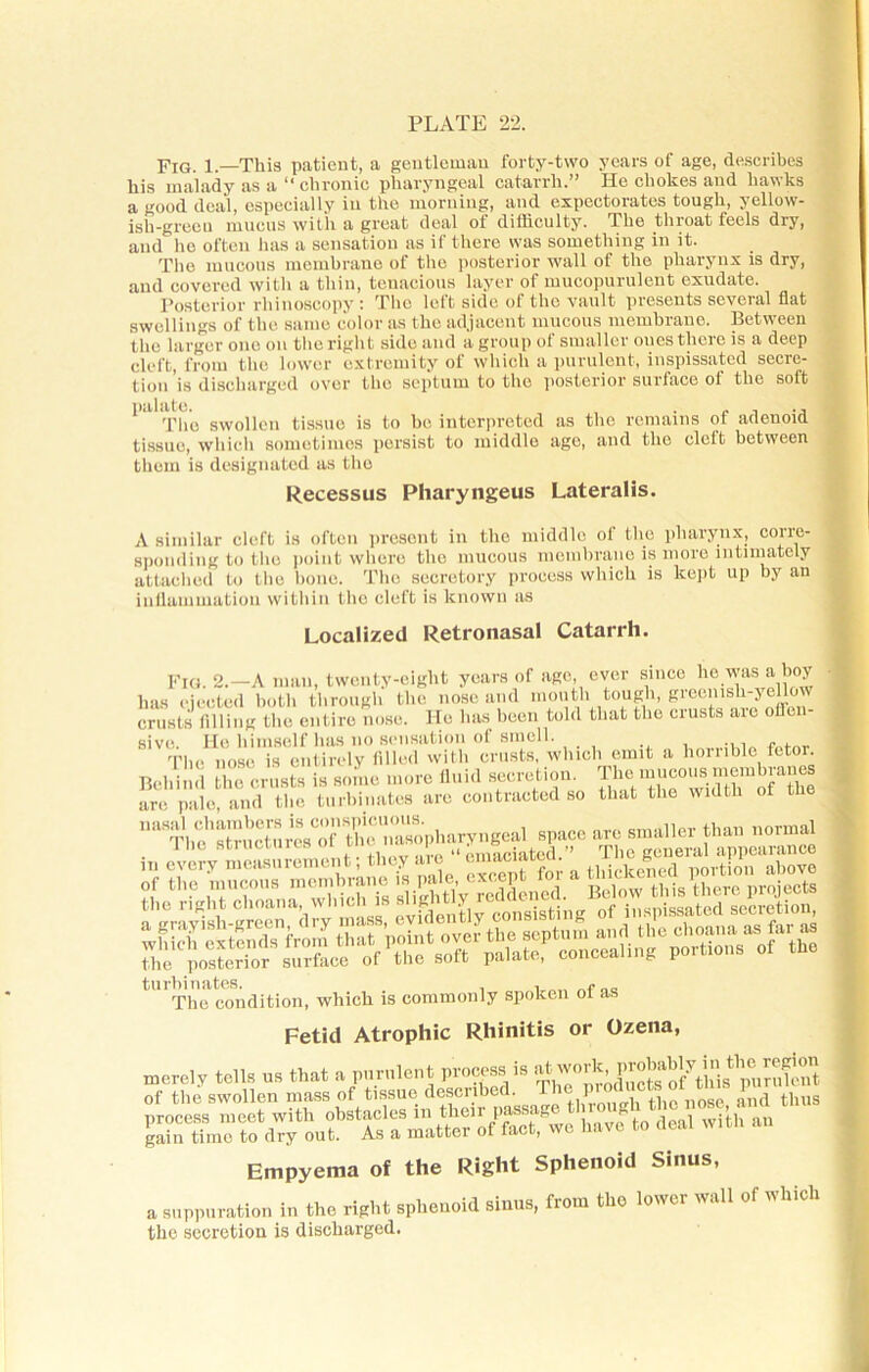 Fig. 1.—This patient, a gentleman forty-two years of age, describes his malady as a “ chronic pharyngeal catarrh.” He chokes and hawks a good deal, especially in the morning, and expectorates tough, yellow- ish-green mucus with a great deal ot difficulty. The throat feels dry, and he often has a sensation as if there was something in it. The mucous membrane of the posterior wall of the pharynx is dry, and covered with a thin, tenacious layer of mucopurulent exudate. Posterior rhinoscopy i The lelt side ot the vault presents scveial flat swellings of the same color as the adjacent mucous membrane. Between the larger one on the right side and a group of smaller ones there is a deep cleft, from the lower extremity of which a purulent, inspissated secre- tion is discharged over the septum to the posterior surface of the soft palate. . . . ., The swollen tissue is to he interpreted as the remains ot adenoid tissue, which sometimes persist to middle age, and the cleft between them is designated as the Recessus Pharyngeus Lateralis. A similar cleft is often present in the middle of the pharynx, corre- sponding to the point where the mucous membrane is more intimately attached to the bone. The secretory process which is kept up by an inflammation within the cleft is known as Localized Retronasal Catarrh. Fig. 2.—A man, twenty-eight years of age, ever since he was a boy has ejected both through the nose and mouth tough, greemsh-yeUow crusts filling the entire nose. He has been told that the ciusts aie olfen sive. He himself has no sensation of smell. ... 'l'lie nose is entirely filled with crusts, which emit a hornble fetor. ssj-rasrsis in every measurement, they aie t-nnic . , ® . w.:on „nove IpiSSi The condition, which is commonly spoken of as Fetid Atrophic Rhinitis or Ozena, merely tells us that a purulent process is of the swollen mass of tissue descnbed. P , ose ^nd thus process meet with obstacles in^“oS^we have to deal with an gain time to dry out. As a mattei ot tact, Empyema of the Right Sphenoid Sinus, a suppuration in the right sphenoid sinus, from the lower wall of which the secretion is discharged.