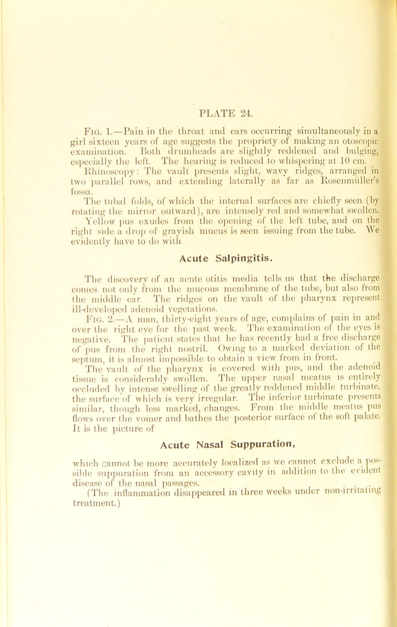 Fro. 1.—Pain in the throat and ears occurring simultaneously in a girl sixteen years of age suggests the propriety of making an otoscopic examination. Both drumheads are slightly reddened and bulging, especially the left. The hearing is reduced to whispering at 10 cm. Rhinoscopy; The vault presents slight, wavy ridges, arranged in two parallel rows, and extending laterally as far as Rosenmuller’s fossa. The tubal folds, of which the internal surfaces are chiefly seen (by rotating the mirror outward), are intensely red and somewhat swollen. Yellow pus exudes from the opening of the left tube, and on the right side a drop of grayish mucus is seen issuing from the tube. We evidently have to do with Acute Salpingitis. 'the discovery of an acute otitis media tells us that the discharge comes not only from the mucous membrane of the tube, but also from the middle ear. The ridges on the vault of the pharynx represent ill-developed adenoid vegetations. _ j Fig. 2.—A man, thirty-eight years of age, complains of pain in and over the right eye for the past week. The examination of the eyes is negative. The patient states that he has recently had a free discharge of pus from the right nostril. Owing to a marked deviation of the septum, it is almost impossible to obtain a view from in front. The vault of the pharynx is covered with pus, and the adenoid tissue is considerably swollen. The upper nasal meatus is entirely occluded by intense swelling of the greatly reddened middle turbinate, the surface of which is very irregular. The inferior turbinate presents similar, though less marked, changes. From the middle meatus pus flows over (he vomer and bathes the posterior surface of the soft palate. It is the picture of Acute Nasal Suppuration, which cannot be more accurately localized as wo cannot exclude a pos- sible suppuration from an accessory cavity in addition to the evident disease of the nasal passages. (The inflammation disappeared in three weeks under non-irritating treatment.)