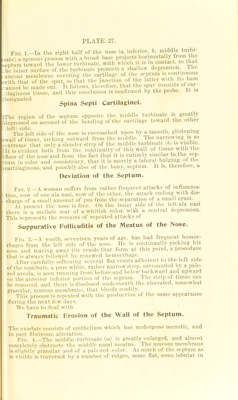 - Fig 1 -In the right half of the nose (a, inferior, 6, middle turbi- iate) a spinous process with a broad base projects horizontally from the i&eptum toward the lower turbinate, with which it is in contact, so that he inner surface of the turbinate presents a shallow depression The mucous membrane covering the cartilage of the septum is cnntiniious .with that of the spur, so that the junction of the latter with its base • anuot be made out It follows, therefore, that the spur consists of car- ilaginous tissue, and this conclusion is confirmed by the probe, it is designated Spina Septi Cartilaginei. TThe region of the septum opposite the middle turbinate is greatly depressed on account of the bending of the cartilage toward the other (left) side. The left side of the nose is encroached upon by a smooth, glistening wall of tissue, arching outward from the middle. The narrowing is so extreme that only a slender strip of the middle turbinate (b) is visible. It is evident both from the continuity of this wall of tissue with the floor of the nose and from the fact that it is entirely similar to the sep- turn iu color and consistency, that it is merely a lateral bulging 01 the cartilaginous, and possibly also of the bony, septum. It is, therefore, a Deviation of the Septum. pIG 2. A woman suffers from rather frequent attacks of inflamma- tion, now of one ala nasi, now of the other, the attack ending with dis- charge of a small amount of pus from the separation of a small crust. At present the nose is free. On the inner side of the left ala nasi there is a stellate scar of a whitish color, with a central depression. This represents the remains of repeated attacks of Suppurative Folliculitis of the Meatus of the Nose. pIG o a youth, seventeen years of age, has had frequent hemor- rhages from the left side of the nose. He is continually picking his nose and tearing away the crusts that form at this point, a procedure that is always followed by renewed hemorrhage. After carefully softening several flat crusts adherent to the left side of the vestibule, a pure white, rather narrow strip, surrounded by a pale- red areola, is seen running from before and below backward and upward on the anterior inferior portion of the septum. I lie strip of tissue can be removed, and there is disclosed underneath the ulcerated, somewhat granular, mucous membrane, that bleeds readily. This process is repeated with the production of the same appearance during the next few days. We have to deal with Traumatic Erosion of the Wall of the Septum. The exudate consists of epithelium which has undergone necrotic, and in part fibrinous, alteration. Fig. 4.—The middle turbinate (m) is greatly enlarged, and almost completely obstructs the middle nasal meatus, fl he mucous membrane is slightly granular and of a pale-red color. As much of the septum as is visible is traversed by a number of ridges, some flat, some lobular in