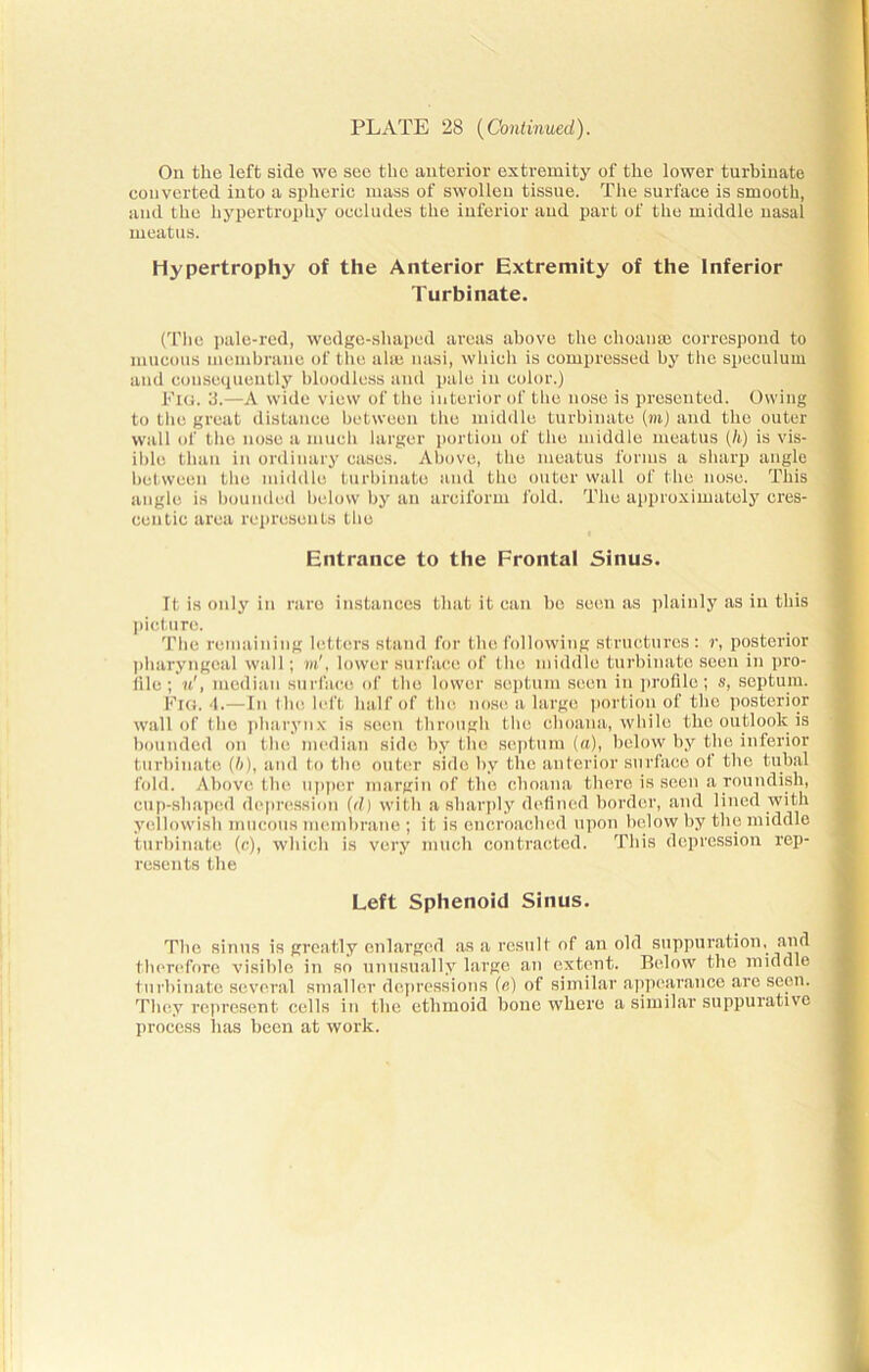 On the left side we see the anterior extremity of the lower turbinate converted into a spheric mass of swollen tissue. The surface is smooth, and the hypertrophy occludes the inferior and part of the middle nasal meatus. Hypertrophy of the Anterior Extremity of the Inferior Turbinate. (The pale-red, wedge-shaped areas above the choanse correspond to mucous membrane of the ahe nasi, which is compressed by the speculum and consequently bloodless and pale in color.) Fig. 3.—A wide view of the interior of the nose is presented. Owing to the great distance between the middle turbinate (m) and the outer wall of the nose a much larger portion of the middle meatus (li) is vis- ible than in ordinary cases. Above, the meatus forms a sharp angle between the middle turbinate and the outer wall of the nose. This angle is bounded below by an arciform fold. The approximately cres- centic area represents the Entrance to the Frontal Sinus. It is only in rare instances that it can be seen as plainly as in this picture. The remaining letters stand for the following structures: r, posterior pharyngeal wall; m', lower surface of the middle turbinate seen in pro- file ; u', median surface of the lower septum seen in profile; s, septum. Fig. 4.—In the left half of the nose a large portion of the posterior wall of the pharynx is seen through the choana, while the outlook is bounded on the median side by the septum (a), below by the inferior turbinate (b), and to the outer side by the anterior surface of tbo tubal fold. Above the upper margin of the choana there is seen a roundish, cup-shaped depression (d) with a sharply defined border, and lined with yellowish mucous membrane ; it is encroached upon below by the middle turbinate (c), which is very much contracted. This depression rep- resents the Left Sphenoid Sinus. The sinus is greatly enlarged as a result of an old suppuration, and therefore visible in so unusually large an extent. Below the middle turbinate several smaller depressions (e) of similar appearance are seen. They represent cells in the ethmoid bone where a similar suppurative process has been at work.