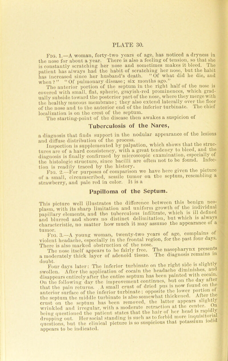 Fig. 1.—A woman, forty-two years of age, has noticed a dryness in the nose for about a year. There is also a feeling of tension, so that she is constantly scratching her nose and sometimes makes it bleed. The patient has always had the habit of scratching her nose, but the habit has increased since her husband’s death. “Of what did he die, and when?” “Of pulmonary disease; six months ago.” The anterior portion of the septum in the right half of the nose is covered with small, flat, spheric, grayish-red prominences, which grad- ual 1 y subside toward the posterior part of the nose, where they merge witk the healthy mucous membrane ; they also extend laterally over the floor of the nose and to the anterior end of the inferior turbinate. The chief localization is on the crost of the septum. The starting-point of the disease then awakes a suspicion of Tuberculosis of the Nares, a diagnosis that finds support in the nodular appearance ol the lesions and diffuse distribution of the process. Inspection is supplemented by palpation, which shows that the struc- tures are of a hard consistency, with a great tendency to bleed, and the diagnosis is finally confirmed by microscopic examination, especially of the histologic structure, since bacilli are often not to bo found. Infec- tion is readily traced by the history. Fig. 2.—For purposes of comparison wc liavo here given the picture of a small, circumscribed, sessile tumor on the septum, resembling a strawberry, and pale red in color. It is a Papilloma of the Septum. This picture well illustrates the difference between this benign neo- plasm, with its sharp limitation and uniform growth ol the individual papillary elements, and the tuberculous infiltrate, which is ill defined and blurred and shows no distinct delimitation, but which is always characteristic, no matter how much it may assume the appearance of a tumor. i • Fig. 3.—A young woman, twenty-two years of age, complains oi violent headache, especially in the frontal region, for the past four days. There is also marked obstruction of the nose. The nose itself appears to be fairly free. The nasopharynx presents a moderately thick layer of adenoid tissue. The diagnosis remains in doubt. Four days later: The inferior turbinate on the right side is slightly swollen. After the application of cocain the headache diminishes, an disappears entirely after the entire septum has been painted with cocain. On the following day the improvement continues, but on the day alter that the pain returns. A small crust of dried pus is now found on u anterior surface of the inferior turbinate; opposite the lower portion oi the septum the middle turbinate is also somewhat thickened. Alter tlie crust on the septum has been removed, the latter appears s lg' . wrinkled and irregular, with a moderate retraction at the center, being questioned the patient states that the hair of her head is rapidly dropping out. Hersocial standing is such as to forbid more inquisitorial questions, but the clinical picture is so suspicious that potassium lodid appears to be indicated.