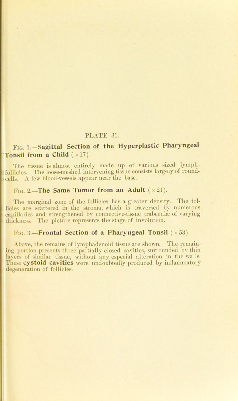 Fig. 1—Sagittal Section of the Hyperplastic Pharyngeal Tonsil from a Child (xl7). The tissue is almost entirely made up of various sized lymph- follicles. The loose-meshed intervening tissue consists largely of round- ■ cells. A few blood-vessels appear near the base. Fig. 2.—The Same Tumor from an Adult (x21). The marginal zone of the follicles has a greater density. The fol- licles are scattered in the stroma, which is traversed by numerous capillaries and strengthened by connective-tissue trabeculae of varying thickness. The picture represents the stage of involution. Fig. 3.—Frontal Section of a Pharyngeal Tonsil (x53). Above, the remains of lymphadenoid tissue are shown. The remain- ing portion presents three partially closed cavities, surrounded by thin layers of similar tissue, without any especial alteration in the walls. These cystoid cavities were undoubtedly produced by inflammatory degeneration of follicles.