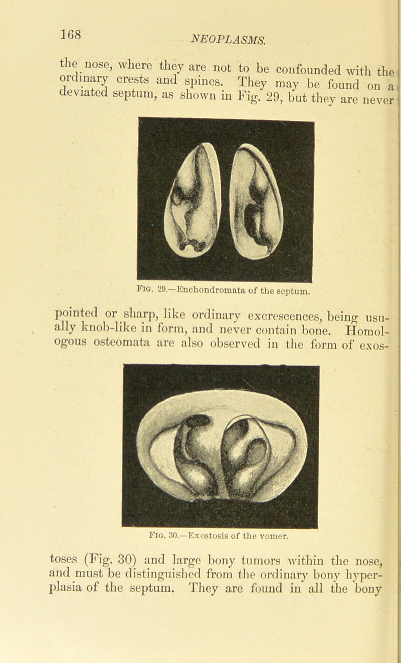 neoplasms. the nose, where they are not to be confounded with the ordinary crests and spines. They may be found on a cwa ec septum, as shown in Fig. 29, but they are never Fig. 29.—Enchondronmta of the septum. pointed or sharp, like ordinary excrescences, being usu- ally knob-like in form, and never contain bone. Homol- ogous osteomata are also observed in the form of exos- Fig. 30.—Exostosis of the vomer. toses (Fig. 30) and large bony tumors within the nose, and must be distinguished from the ordinary bony hyper- plasia of the septum. They are found in all the bony