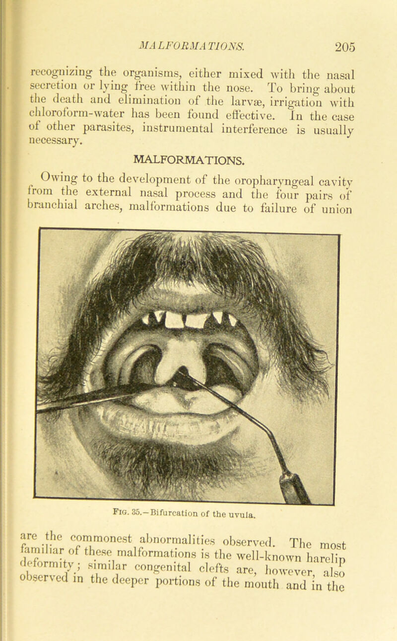 recognizing the organisms, either mixed with the nasal se on 01 lyin g free within the nose. To bring about the death and elimination of the larvae, irrigation with chloroform-water has been found effective. In the case of other parasites, instrumental interference is usually necessary. MALFORMATIONS. Owing to the development of the oropharyngeal cavity from the external nasal process and the four pairs of branchial arches, malformations due to failure of union Fig. 35.-Bifurcation of the uvula. are the commonest abnormalities observed. The most fam.liar of these malformations is the well-known haSip deformity ; similar congenital clefts are, however also observed in the deeper portions of the mouth and in the