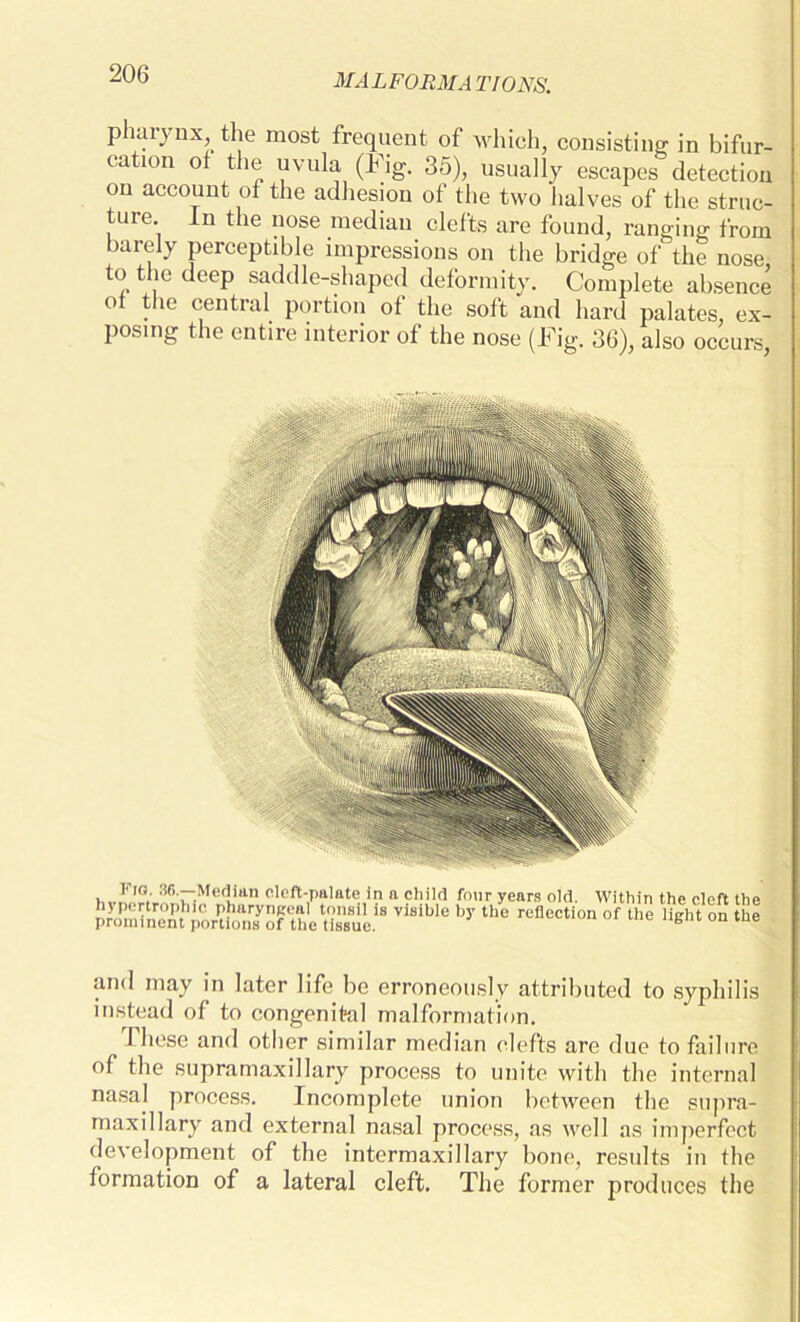 pharynx, the most frequent of which, consisting in bifur- cation of the uvula (Fig. 35), usually escapes detection on account of the adhesion of the two halves of the struc- ture. In the nose median clefts are found, ranging from barely perceptible impressions on the bridge of the nose to the deep saddle-shaped deformity. Complete absence ot the central portion of the soft and hard palates, ex- posing the entire interior of the nose (Fig. 36), also occurs, Fig. 36.—Median cleft-palate in a child four years old. Within the cleft the pronOncm portionTof ^he^s^ue!8 ViSiblC by thC rcfloction of lhe U«ht the ami may in later life be erroneously attributed to syphilis instead of to congenital malformation. 1 hose and other similar median clefts are due to failure of the supramaxillary process to unite with the internal nasal process. Incomplete union between the supra- maxillary and external nasal process, as well as imperfect development of the intermaxillary bone, results in the formation of a lateral cleft. The former produces the