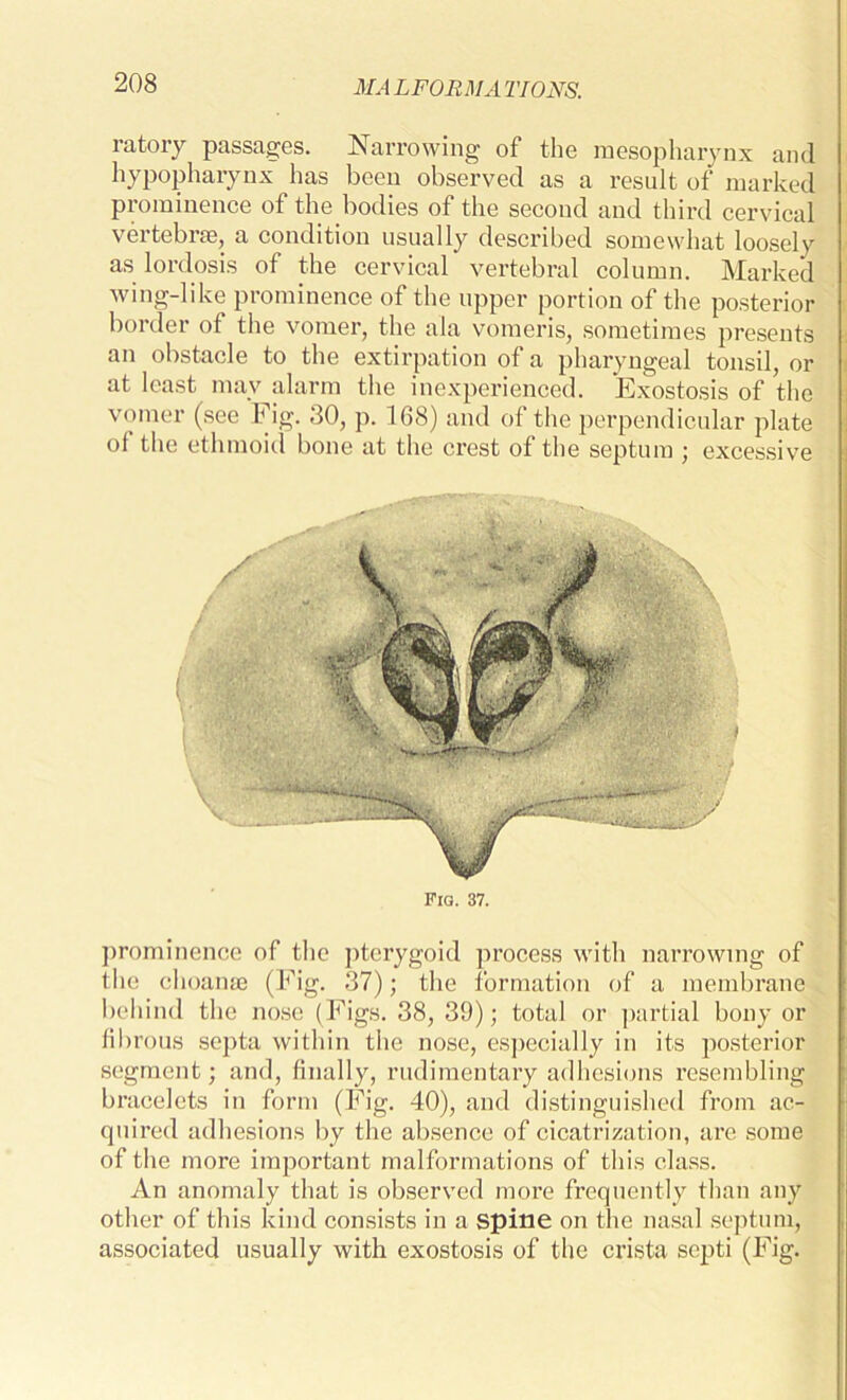 ratory passages. Narrowing of the mesopharynx and hypopharynx has been observed as a result of marked prominence of the bodies of the second and third cervical vertebrae, a condition usually described somewhat loosely as lordosis of the cervical vertebral column. Marked wing-like prominence of the upper portion of the posterior border of the vomer, the ala vomeris, sometimes presents an obstacle to the extirpation of a pharyngeal tonsil, or at least mav alarm the inexperienced. Exostosis of the vomer (see Fig. 30, p. 168) and of the perpendicular plate ol the ethmoid bone at the crest of the septum ; excessive Fig. 37. prominence of the pterygoid process with narrowing of the choanae (Fig. 37); the formation of a membrane behind the nose (Figs. 38, 39); total or partial bony or fibrous septa within the nose, especially in its posterior segment; and, finally, rudimentary adhesions resembling bracelets in form (Fig. 40), and distinguished from ac- quired adhesions by the absence of cicatrization, are some of the more important malformations of this class. An anomaly that is observed more frequently than any other of this kind consists in a Spine on the nasal septum, associated usually with exostosis of the crista septi (Fig.