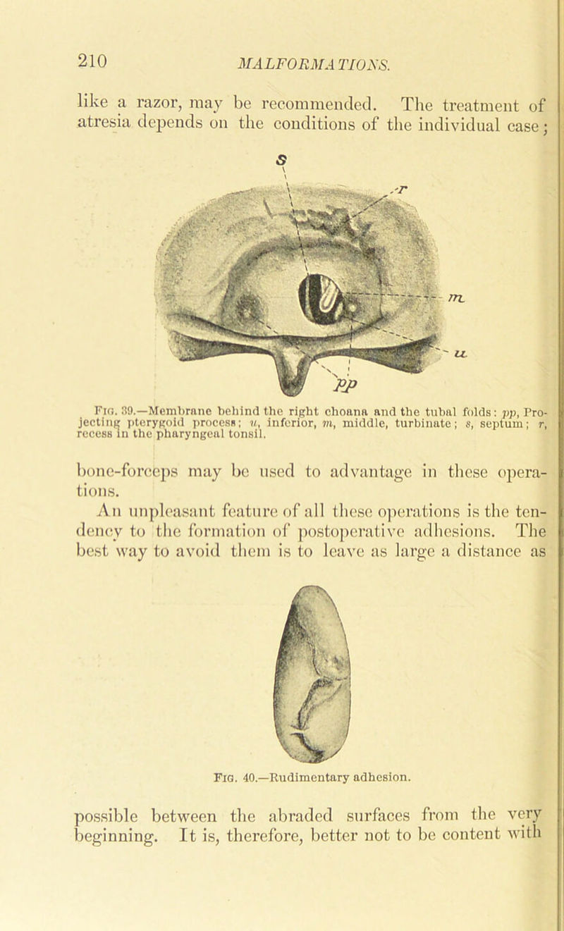 like a razor, may be recommended. The treatment of atresia depends on the conditions of the individual case; s \ Fig. 39.—Membrane behind the right choana and the tubal folds: pp, Pro- jecting pterygoid process; u, inferior, m, middle, turbinate; s, septum; r, recess in the pharyngeal tonsil. bone-forceps may be used to advantage in these opera- tions. An unpleasant feature of all these operations is the ten- dency to the formation of postoperative adhesions. The best way to avoid them is to leave as large a distance as Fig. 40.—Rudimentary adhesion. possible between the abraded surfaces from the very beginning. It is, therefore, better not to be content with