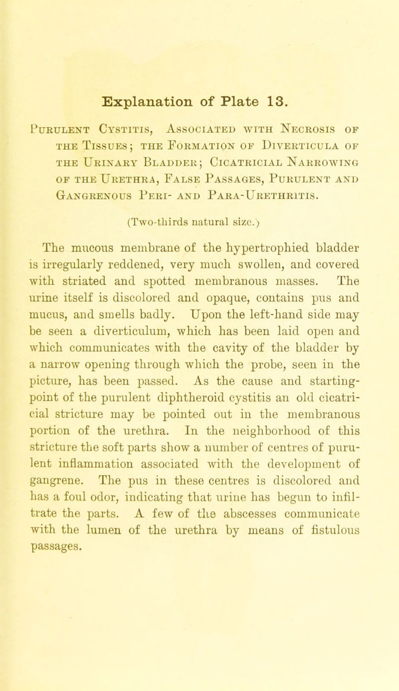 Purulent Cystitis, Associated with Necrosis of the Tissues; the Formation of Diverticula of the Urinary Bladder; Cicatricial Narrowing of the Urethra, False Passages, Purulent and Gangrenous Peri- and Para-Urethritis. (Two-thirds natural size.) The mucous membrane of the hypertrophied bladder is irregularly reddened, very much swollen, and covered with striated and spotted membranous masses. The urine itself is discolored and opaque, contains pus and mucus, and smells badly. Upon the left-hand side may be seen a diverticulum, which has been laid open and which communicates with the cavity of the bladder by a narrow opening through which the probe, seen in the picture, has been passed. As the cause and starting- point of the purulent diphtheroid cystitis an old cicatri- cial stricture may be pointed out in the membranous portion of the urethra. In the neighborhood of this stricture the soft parts show a number of centres of puru- lent inflammation associated with the development of gangrene. The pus in these centres is discolored and has a foul odor, indicating that urine has begun to infil- trate the parts. A few of the abscesses communicate with the lumen of the urethra by means of fistulous passages.