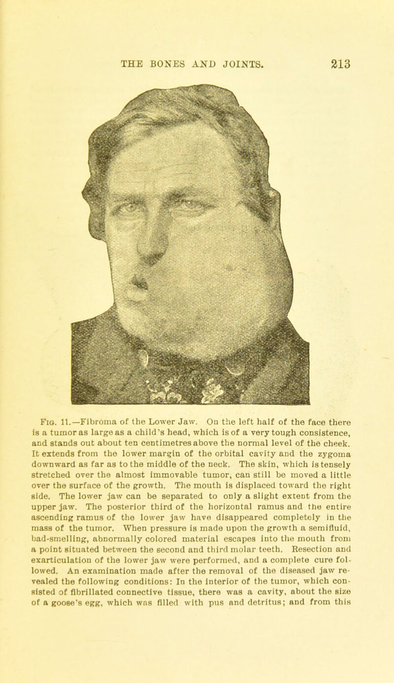 Fig. It.—Fibroma of the Lower Jaw. On the left half of the face there is a tumor as large as a child’s head, which is of a very tough consistence, and stands out about ten centimetres above the normal level of the cheek. It extends from the lower margin of the orbital cavity and the zygoma downward as far as to the middle of the neck. The skin, which is tensely stretched over the almost immovable tumor, can still be moved a little over the surface of the growth. The mouth is displaced toward the right side. The lower jaw can be separated to only a slight extent from the upper jaw. The posterior third of the horizontal ramus and the entire ascending ramus of the lower jaw have disappeared completely in the mass of the tumor. When pressure is made upon the growth a semifluid, bad-smelling, abnormally colored material escapes into the mouth from a point situated between the second and third molar teeth. Resection and exarticulation of the lower jaw were performed, and a complete cure fol- lowed. An examination made after the removal of the diseased jaw re- vealed the following conditions: In the interior of the tumor, which con- sisted of flbrillated connective tissue, there was a cavity, about the size of a goose’s egg, which was filled with pus and detritus; and from this