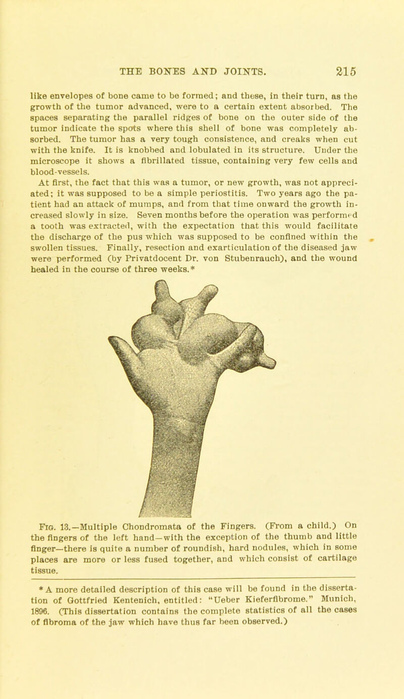 like envelopes of bone came to be formed; and these, in their turn, as the growth of the tumor advanced, were to a certain extent absorbed. The spaces separating the parallel ridges of bone on the outer side of the tumor indicate the spots where this shell of bone was completely ab- sorbed. The tumor has a very tough consistence, and creaks when cut with the knife. It is knobbed and lobulated in its structure. Under the microscope it shows a fibrillated tissue, containing very few cells and blood-vessels. At first, the fact that this was a tumor, or new growth, was not appreci- ated; it was supposed to be a simple periostitis. Two years ago the pa- tient had an attack of mumps, and from that time onward the growth in- creased slowly in size. Seven months before the operation was performed a tooth was extracted, with the expectation that this would facilitate the discharge of the pus wThich was supposed to be confined within the swollen tissues. Finally, resection and exarticulation of the diseased jaw were performed (by Privatdocent Dr. von Stubenrauch), and the wound healed in the course of three weeks.* Fig. 13.—Multiple Chondromata of the Fingers. (From a child.) On the fingers of the left hand—with the exception of the thumb and little finger—there is quite a number of roundish, hard nodules, which in some places are more or less fused together, and which consist of cartilage tissue. * A more detailed description of this case will be found in the disserta- tion of Gottfried Kentenich, entitled: “Ueber Kieferflbrome.” Munich, 1896. (This dissertation contains the complete statistics of all the cases of fibroma of the jaw which have thus far been observed.)