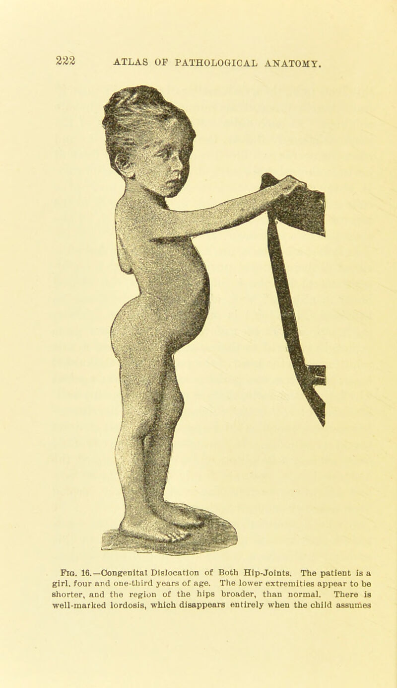 Fig. 16.—Congenital Dislocation of Both Hip-Joints. The patient is a girl, four and one-third years of age. The lower extremities appear to be shorter, and the region of the hips broader, than normal. There is well-marked lordosis, which disappears entirely when the child assumes