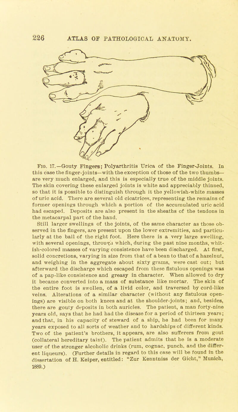 Fig. 17.—Gouty Fingers; Polyarthritis Urica of the Finger-Joints. In this case the finger-joints—with the exception of those of the two thumbs— are very much enlarged, and this is especially true of the middle joints. The skin covering these enlarged joints is white and appreciably thinned, so that it is possible to distinguish through it the yellowish-white masses of uric acid. There are several old cicatrices, representing the remains of former openings through which a portion of the accumulated uric acid had escaped. Deposits are also present in the sheaths of the tendons in the metacarpal part of the hand. Still larger swellings of the joints, of the same character as those ob- served in the fingers, are present upon the lower extremities, and particu- larly at the ball of the right foot. Here there is a very large swelling, with several openings, through which, during the past nine months, whit- ish-colored masses of varying consistence have been discharged. At first, solid concretions, varying in size from that of a bean to that of a hazelnut, and weighing in the aggregate about sixty grams, were cast out; but afterward the discharge which escaped from these fistulous Openings was of a pap-like consistence and greasy in character. When allowed to dry it became converted into a mass of substance like mortar. The skin of the entire foot is swollen, of a livid color, and traversed by cord-like veins. Alterations of a similar character (without any fistulous open- ings) are visible on both knees and at the shoulder-joints; and, besides, there are gouty deposits in both auricles. The patient, a man forty-nine years old, says that he had had the disease for a period of thirteen years; and that, in his capacity of steward of a ship, he had been for many years exposed to all sorts of weather and to hardships of different kinds. Two of the patient’s brothers, it appears, are also sufferers from gout (collateral hereditary taint). The patient admits that he is a moderate user of the stronger alcoholic drinks (rum, cognac, punch, and the differ- ent liqueurs). (Further details in regard to this case will be found in the dissertation of H. Keiper, entitled: “Zur Kenntniss der Gicht,” Munich, 1889.)