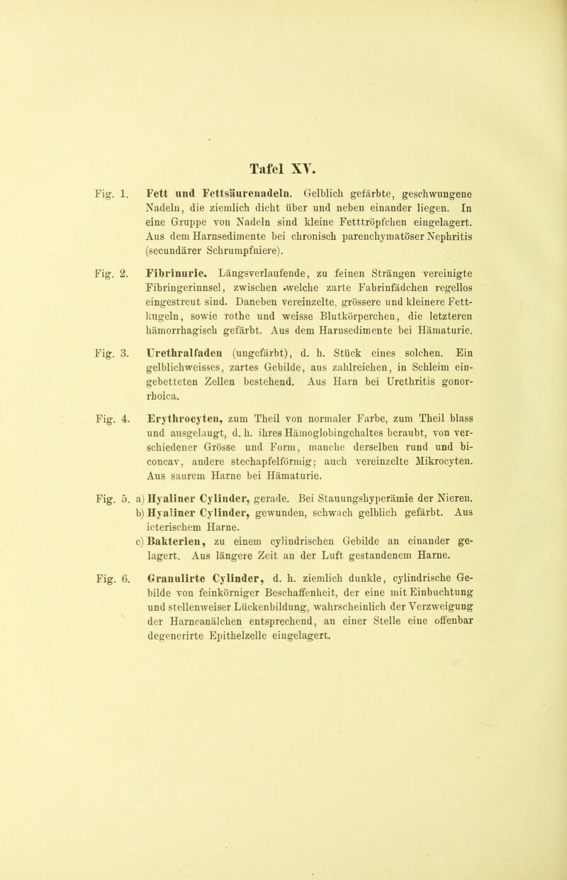 Fig. 1. Fett und Fettsäurenadeln. Gelblich gefärbte, geschwungene Nadeln, die ziemlich dicht über und neben einander liegen. In eine Gruppe von Nadeln sind kleine Fetttröpfchen eingelagert. Aus dem Harnsedimente bei chronisch parenchymatöser Nephritis (secundärer Schrumpfniere). Fig. 2. Fibrinurie. Längsverlaufende, zu feinen Strängen vereinigte Fibringerinnsel, zwischen .welche zarte Fabrinfädchen regellos eingestreut sind. Daneben vereinzelte, grössere und kleinere Fett- kugeln, sowie rothe und weisse Blutkörperchen, die letzteren hämorrhagisch gefärbt. Aus dem Harnsedimente bei Hämaturie. Fig. 3. Urethralfaden (ungefärbt), d. h. Stück eines solchen. Ein gelblichweisses, zartes Gebilde, aus zahlreichen, in Schleim ein- gebetteten Zellen bestehend. Aus Harn bei Urethritis gonor- rhoica. Fig. 4. Erythrocyten, zum Theil von normaler Farbe, zum Theil blass und ausgelaugt, d. h. ihres Hämoglobingehaltes beraubt, von ver- schiedener Grösse und Form, manche derselben rund und bi- concav, andere stechapfelförmig,- auch .vereinzelte Mikrocyten. Aus saurem Harne bei Hämaturie. Fig. 5. a) Hyaliner Oylinder, gerade. Bei Stauungshyperämie der Nieren. b) Hyaliner Oy linder, gewunden, schwach gelblich gefärbt. Aus icterischem Harne. c) Bakterien, zu einem cylindrischen Gebilde an einander ge- lagert. Aus längere Zeit an der Luft gestandenem Harne. Fig. 6. Granulirte Cylinder, d. h. ziemlich dunkle, cylindrische Ge- bilde von feinkörniger Beschaffenheit, der eine mit Einbuchtung und stellenweiser Lückenbildung, wahrscheinlich der Verzweigung der Harncanälclien entsprechend, an einer Stelle eine offenbar degenerirte Epithelzelle eingelagert.