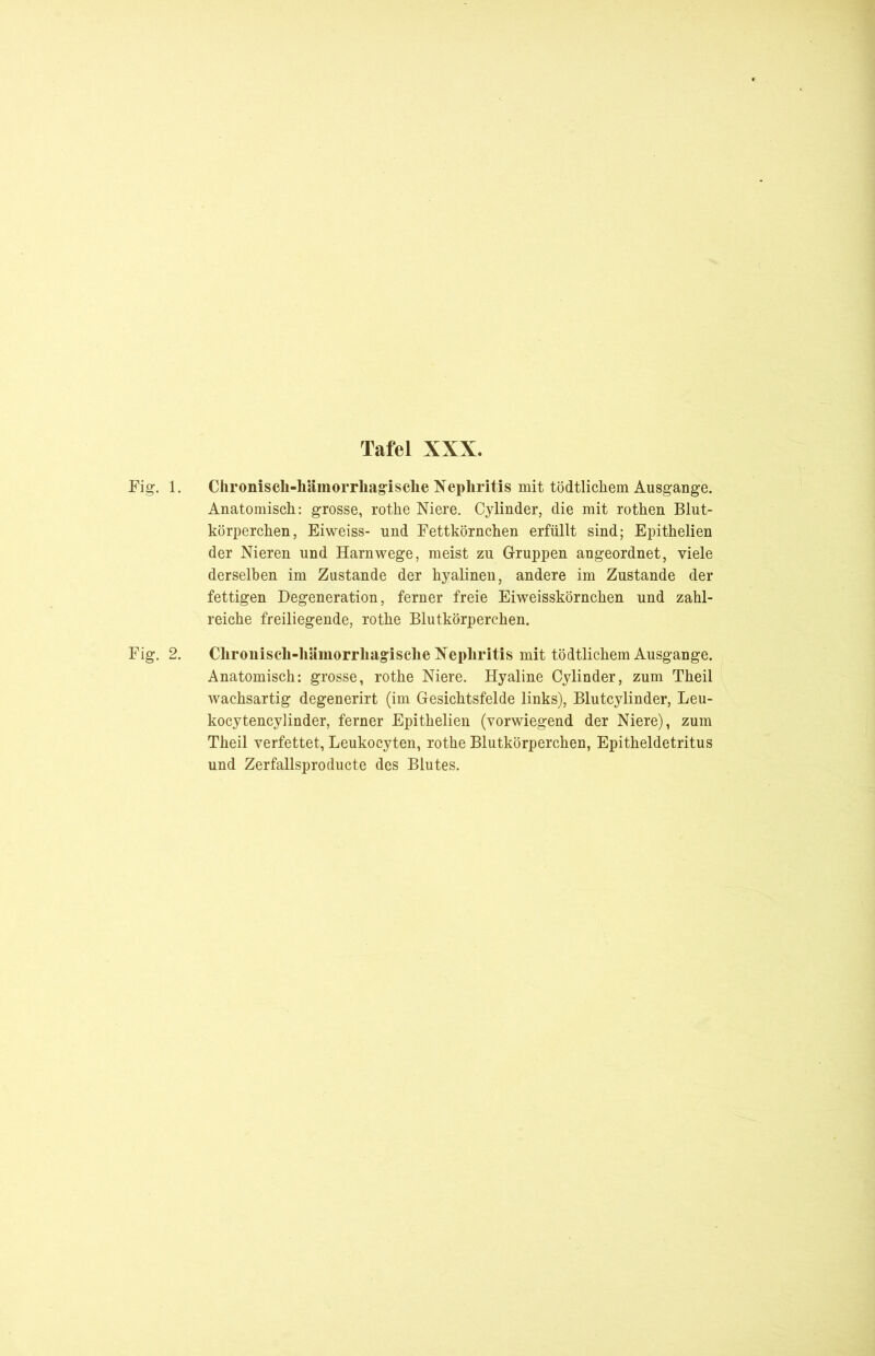 Fig. 1. Chronisch-hämorrhagische Nephritis mit tödtlichem Ausgange. Anatomisch: grosse, rothe Niere. Cylinder, die mit rothen Blut- körperchen, Eiweiss- und Fettkörnchen erfüllt sind; Epithelien der Nieren und Harnwege, meist zu Gruppen angeordnet, viele derselben im Zustande der hyalinen, andere im Zustande der fettigen Degeneration, ferner freie Eiweisskörnchen und zahl- reiche freiliegende, rothe Blutkörperchen. Fig. 2. Chronisch-hämorrhagische Nephritis mit tödtlichem Ausgange. Anatomisch: grosse, rothe Niere. Hyaline Cylinder, zum Theil wachsartig degenerirt (im Gesichtsfelde links), Blutcylinder, Leu- kocytencylinder, ferner Epithelien (vorwiegend der Niere), zum Theil verfettet, Leukocyten, rothe Blutkörperchen, Epitheldetritus und Zerfallsproducte des Blutes.