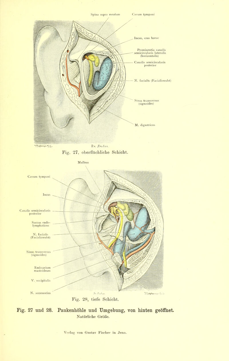 Spina sui)ra meatum Cavum tympani Incus, crus breve Prominentia canalis semicircularis lateralis (horizontalis) Canalis semicircularis posterior N. facialis (Facialiswulst) Sinus transversus (sigmoides) M. digastricus Pig. 27, oberflächliche Schicht. Malleus Cavum tympani Canalis semicircularis posterior Saccus endo- lymphaticus N. facialis (Facialiswulst) Sinus transversus (sigmoides) Emissarium mastoideum V. occipitalis N. accessorius Fig. 28, tiefe Schicht. Fig. 27 und 28, Paukenhöhle und Umgebung, von hinten geöffnet. Natürliche Größe.
