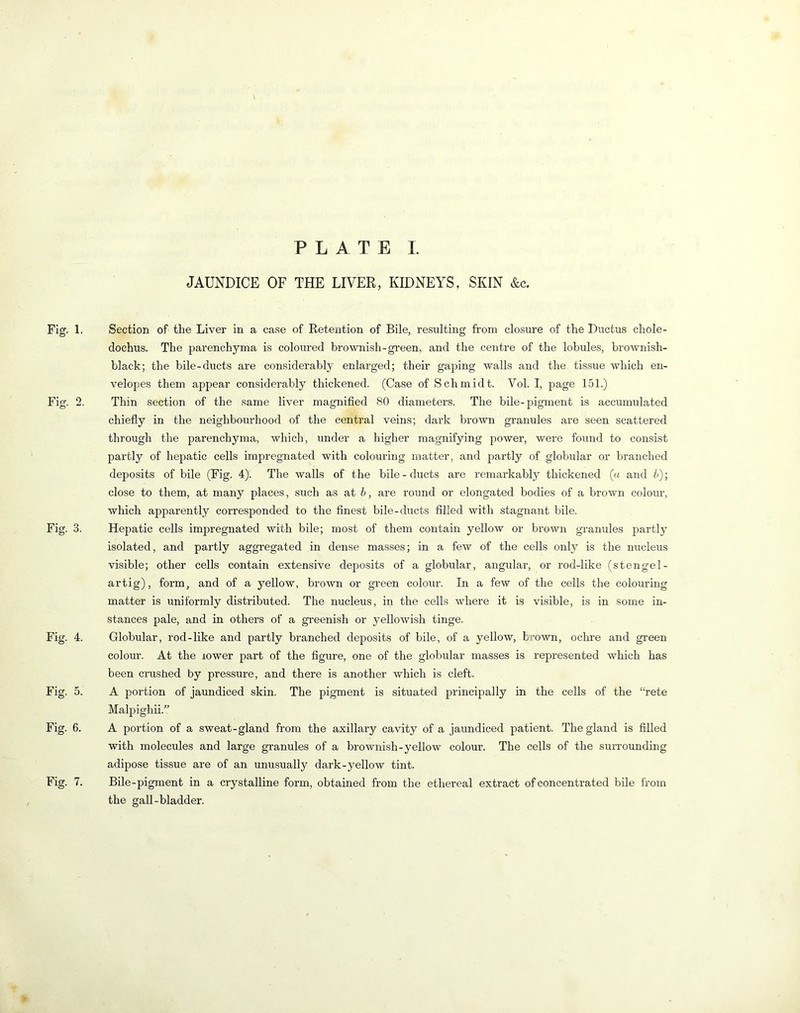 PLATE I. Fig. 1. Fig. 2. Fig. 3. Fig. 4. Fig. 5. Fig. 6. Fig. 7. JAUNDICE OF THE LIVER, KIDNEYS, SKIN &c. Section of the Liver in a case of Retention of Bile, resulting from closure of the Ductus chole- dochus. The parenchyma is coloured brownish-green, and the centre of the lobules, brownish- black; the bile-ducts are considerably enlai’ged; their gaping walls and the tissue which en- velopes them appear considerably thickened. (Case of Schmidt. Vol. I, page 151.) Thin section of the same liver magnified 80 diameters. The bile-pigment is accumulated chiefly in the neighbourhood of the central veins; dark brown granules are seen scattered through the parenchyma, Avhich, under a higher magnifying power, were found to consist partly of hepatic cells impregnated with colouring matter, and partly of globular or branched deposits of bile (Fig. 4). The walls of the bile-ducts are remarkably thickened (a and h); close to them, at many places, such as at b, are round or elongated bodies of a brown colour, which apparently corresponded to the finest bile-ducts filled with stagnant bile. Hepatic cells impregnated with bile; most of them contain yellow or brown granules partly isolated, and partly aggregated in dense masses; in a few of the cells only is the nucleus visible; other cells contain extensive deposits of a globular, angular, or rod-like (stengel- artig), form, and of a yellow, brown or green colour. In a few of the cells the colouring matter is uniformly distributed. The nucleus, in the cells where it is visible, is in some in- stances pale, and in others of a gveenish or yellowi.sh tinge. Globular, rod-like and partly branched deposits of bile, of a yellow, brown, ochre and green colour. At the lower part of the figure, one of the globular masses is represented which has been crushed by pressure, and there is another which is cleft. A portion of jaundiced skin. The pigment is situated principally in the cells of the “rete Malpighii.” A portion of a sweat-gland from the axillary cavity of a jaundiced patient. The gland is fiUed with molecules and large granules of a brownish-yellow colour. The cells of the surrounding adipose tissue are of an unusually dark-yellow tint. Bile-pigment in a crystalline form, obtained from the ethereal extract of concentrated bile from the gall-bladder.
