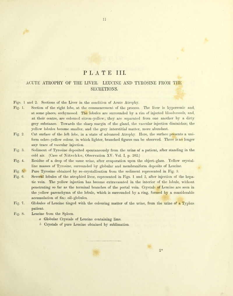 PLATE III ACUTE ATROPHY OF THE LIVER. LEUCINE AND TYROSINE FROxM THE SECRETIONS. Figs, i and 2. Sections of the Liver in the condition of Acute Atrophy. Fig. 1. Section of the right lobe, at the commencement of the process. The liver is hyperaemic and, at some places,- ecchymosed. The lobules are surrounded by a rim of injected bloodvessels, and, at their centre, are coloured citron-yellow; they are separated from one another by a dirty grey substance. Towards the sharp margin of the gland, the vascular injection diminishes; the yellow lobules become smaller, and the grey interstitial matter, more abundant. Fig. 2. Cut surface of the left lobe, in a state of advanced Atropliy. Here, the surface presents a uni- form ochre-yellow colour, in which lighter, branched figures can be observed. There is no longer any trace of vascular injection. Fig. 3. Sediment of Tyrosine deposited spontaneously from the urine of a patient, after standing in the cold air. (Case of Nitschke, Observation XV. Vol. I, p. 202.) Fig. 4. Residue of a drop of the same urine, after evaporation upon the object-glass. Yellow crystal- line masses of Tyrosine, surrounded by globular and membraniform deposits of Leucine. Fig. 5. Pure Tyrosine obtained by re-crystallisation from the sediment represented in Fig. 3. Fig. 6. Several lobules of the atrophied liver, represented in Figs. 1 and 2, after injection of the hepa- tic vein. The yellow injection has become extravasated in the interior of the lobule, without penetrating so far as the terminal branches of the portal vein. Crystals of Leucine are seen in the yellow parenchyma of the lobule, which is surrounded by a ring, formed by a considerable accumulation of fine oil-globules. Fig. 7. Globules of Leucine tinged with the colouring matter of the urine, from the urine of a Typhus patient. Fig. 8. Leucine from the Spleen. a Globular Crystals of Leucine containing lime. If Crystals of pure Leucine obtained by sublimation.