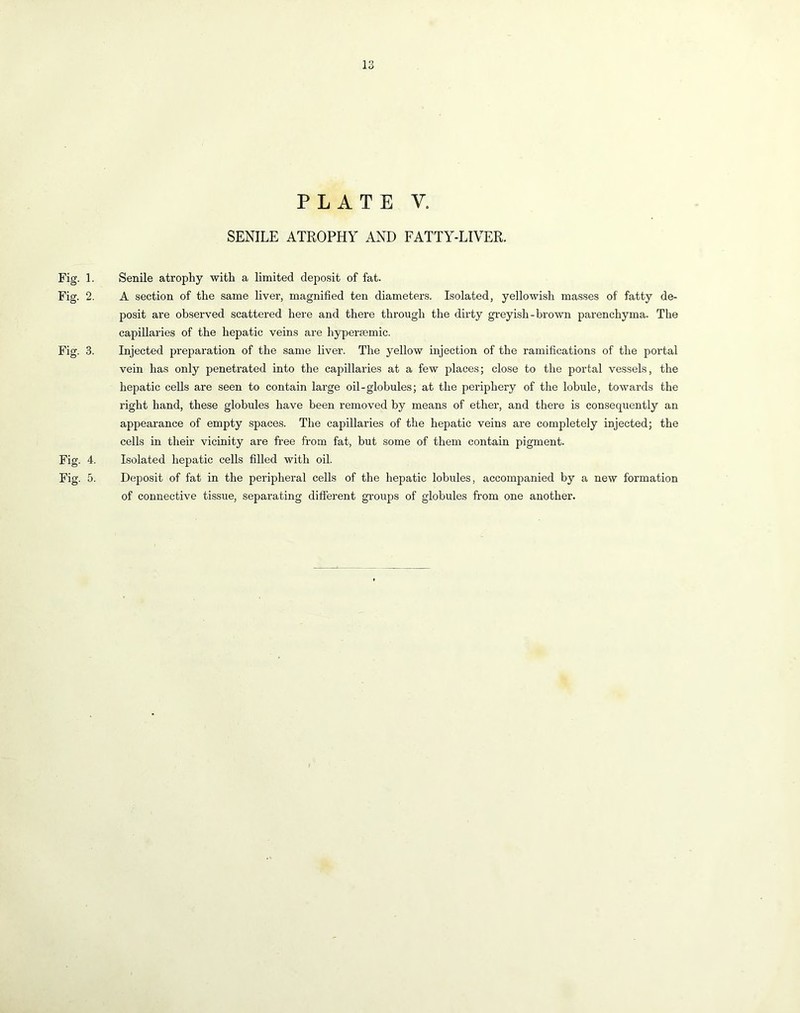 PLATE V. SENILE ATROPHY AND FATTY-LIVER. Fig. 1. Senile atrophy with a limited deposit of fat. Fig. 2. A section of the same liver, magnified ten diameters. Isolated, yellowish masses of fatty de- posit are observed scattered here and there through the dirty gi-eyish-brown parenchyma. The capillaries of the hepatic veins are hypereemic. Fig. 3. Injected preparation of the same liver. The yellow injection of the ramifications of the portal vein has only penetrated into the capillaries at a few places; close to the portal vessels, the hepatic cells are seen to contain large oil-globules; at the periphery of the lobule, towards the right hand, these globules have been removed by means of ether, and there is consequently an appearance of empty spaces. The capillaries of the hepatic veins are completely injected; the cells in their vicinity are free from fat, but some of them contain pigment. Fig. 4. Isolated hepatic cells filled with oil. Fig. 5. Deposit of fat in the peripheral cells of the hepatic lobules, accompanied by a new formation of connective tissue, separating different gi’oups of globules from one another.