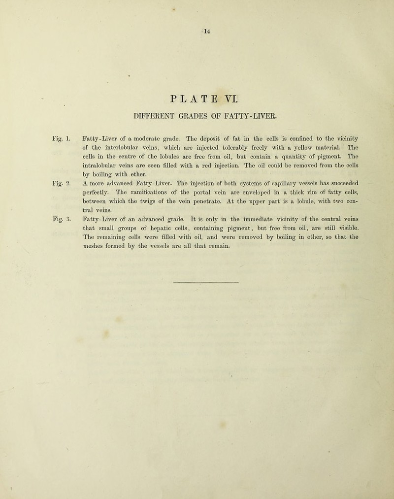 PLATE YI DIFFERENT GRADES OF FATTY-LIVER. Fig. 1. Fatty-Liver of a moderate grade. The deposit of fat in the cells is confined to the vicinity of the interlobular veins, which are injected tolerably freely with a yellow material. The cells in the centre of the lobules are free from oil, but contain a quantity of pigment. The intralobular veins are seen filled with a red injection. The oil could be removed from the cells by boiling with ether. Fig. 2. A more advanced Fatty-Liver. The injection of both systems of capillary vessels has succeeded perfectly. The ramifications of the portal vein are enveloped in a thick rim of fatty cells, between which the twigs of the vein penetrate. At the upper part is a lobule, with two cen- tral veins. Fig. 3. Fatty-Liver of an advanced grade. It is only in the immediate vicinity of the central veins that small groups of hepatic cells, containing pigment, but free from oil, are still visible. The remaining cells were filled with oil, and were removed by boiling in ether, so that the meshes formed by the vessels are all that remain.
