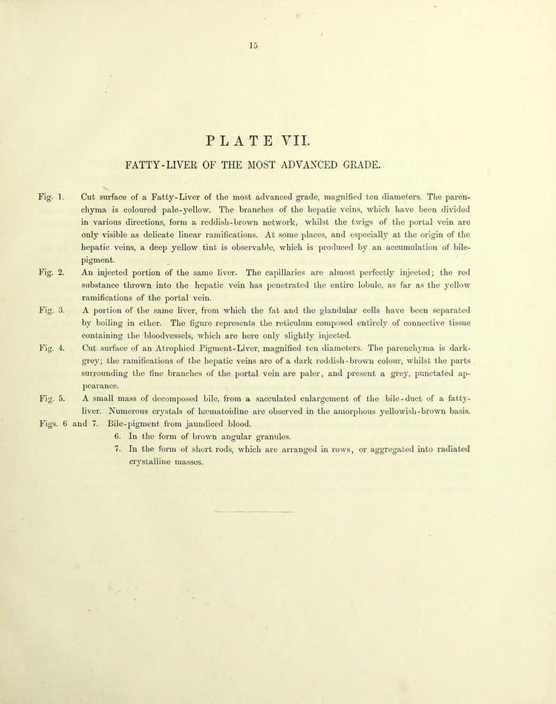 Fig. 1 Fig. 2 Fig. 3 Fig. 4 Fig. 5 Figs. PLATE YIL FATTY-LIVER OF THE MOST ADVANCED GRADE. Cut surface of a Fatty-Liver of the most advanced grade, magnified ten diameters. The paren- chyma is coloured pale-yellow. The branches of the hepatic veins, which have been divided in various directions, form a reddish-brown network, whilst the twigs of the portal vein are only visible as delicate linear ramifications. At some places, and especially at the origin of the hepatic veins, a deep yellow tint is observable, which is produced by an accumulation of bile- pigment. An injected portion of the same liver. The capillaries are almost perfectly injected; the red substance thrown into the hepatic vein has penetrated the entire lobule, as far as the yellow ramifications of the portal vein. A portion of the same liver, from which the fat and the glandular cells have been separated by boiling in ether. The figure represents the reticulum composed entirely of connective tissue containing the bloodvessels, which are here only slightly injected. Cut surface of an Atrophied Pigment-Liver, magnified ten diameters. The parenchyma is dark- grey; the ramifications of the hepatic veins are of a dark reddish-brown colour, whilst the parts surrounding the fine branches of the portal vein are paler, and present a grey, punctated ap- pearance. . A small mass of decomposed bile, from a sacculated enlargement of the bile-duct of a fatty- liver. Numerous crystals of htematoidine are observed in the amorphous yellowish-brown basis. 6 and 7. Bile-pigment from jaundiced blood. 6. In the form of brown angular granules. 7. In the form of short rods, which are arranged in rows, or aggregated into radiated crystalline masses.