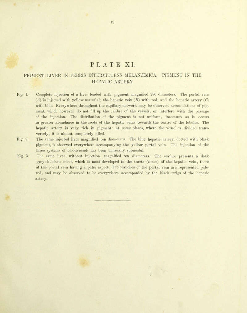 PLATE XL PIGMENT-LIVER IN FEBRIS INTERMITTENS MELANJ^MICA. PIGMENT IN THE HEPATIC ARTERY. Fig. 1. Complete injection of a liver loaded with pigment, magnified 280 diameters. The portal vein {A) is injected with yellow material; the hepatic vein {B) with red; and the hepatic artery {C) with blue. Everywhere throughout the capillary network may be observed accumulations of pig- ment, which however do not fill up the calibre of the vessels, or interfere with the passage of the injection. The distribution of the pigment is not uniform, inasmuch as it occurs in greater abundance in the roots of the hepatic veins towards the centre of the lobules. The hepatic artery is ver}'- rich in pigment- at some places, where the vessel is divided trans- versely, it is almost completely filled. Fig. 2. The same injected liver magnified ten diameters. The blue hepatic artery, dotted with black pigment, is observed everywhere accompanying the yellow portal vein. The injection of the three systems of bloodvessels has been unusually successful. Fig. 3. The same liver, without injection, magnified ten diameters. The surface presents a dark greyish-black coour, which is most developed in the tracts (zones) of the hepatic vein, those of the portal vein having a paler aspect. The branches of the portal vein are re2:>resented pale- red , and may be observed to be everywhere accompanied by the black twigs of the hepatic artery.