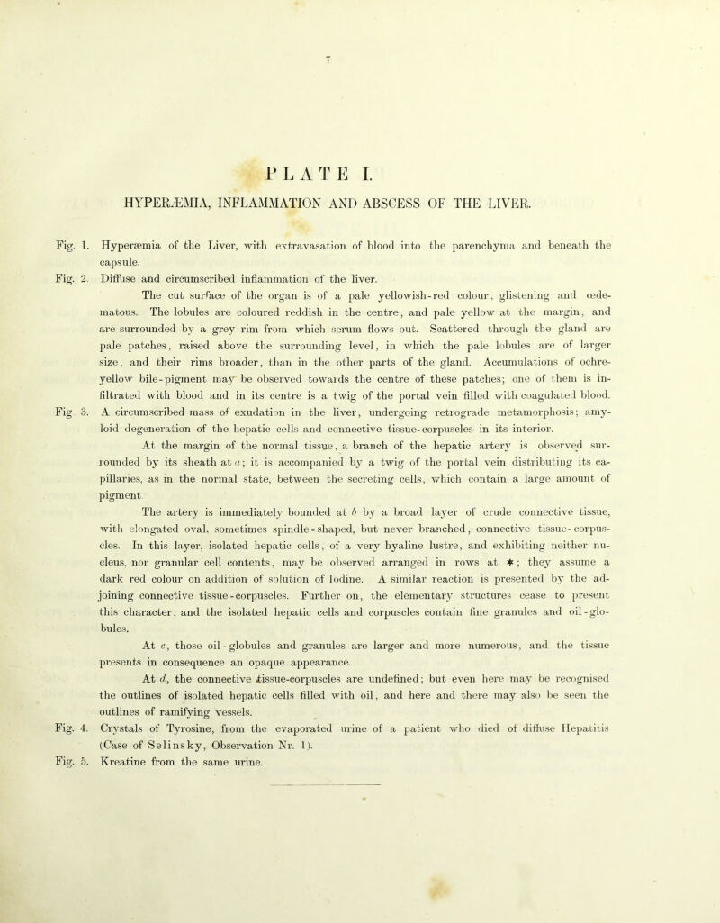 PLATE L HYPEREMIA, INFLAMMATION AND ABSCESS OF THE LIVER. Fig. 1. Hypersemia of the Liver, with extravasation of blood into the parenchyma and beneath the capsule. Fig. 2. Diffuse and circumscribed inflammation of the liver. The cut surface of the organ is of a pale yellowish - red colour, glistening and (ede- matous. The lobules are coloured reddish in the centre, and pale yellow at the margin, and are surrounded by a grey rim froin which serum flows out. Scattered through the gland are pale patches, raised above tlie surrounding level, in which the pale lobules are of larger size, and their rims broader, than in the other parts of the gland. Accumulations of ochre- yellow bile-pigment may be observed towards the centre of these patches; one of them is in- filtrated with blood and in its centre is a twig of the portal vein filled with coagulated Vjlood. Fig. 3. A circumscribed mass of exudation in the liver, undergoing retrograde metamoriDhosis; amy- loid degeneration of the hepatic cells and connective tissue-corpuscles in its interior. At the margin of the normal tissue, a branch of the hepatic artery is observed sur- rounded by its sheath atu; it is accompanied by a twig of the portal vein distributing its ca- pillaries, as in the normal state, between the secreting cells, which contain a large amount of pigment. The artery is immediately bounded at /> by a broad layer of crude connective tissue, with elongated oval, sometimes spindle-shaped, but never branched, connective tissue-corpus- cles. In this layer, isolated hepatic cells, of a very hyaline lustre, and exhibiting neither nu- cleus, nor granular cell contents, may be observed arranged in rows at ♦ ; they assume a dark red colour on addition of solution of Iodine. A similar reaction is presented by the ad- joining connective tissue-corpuscles. Further on, the elementary structures cease to present this character, and the isolated hepatic cells and corpuscles contain fine granules and oil-glo- bules. At c, those oil - globules and granules are larger and more numerous, and the tissue presents in consequence an opaque appearance. At d, the connective iissue-corpuscles are undefined; but even here may be recognised the outlines of isolated hepatic cells filled with oil, and here and there may also be seen the outlines of ramifying vessels. Fig. 4. Crystals of Tyrosine, from the evaporated urine of a patient who died of diffuse Hepatitis (Case of Selinsky, Observation Nr. 1).