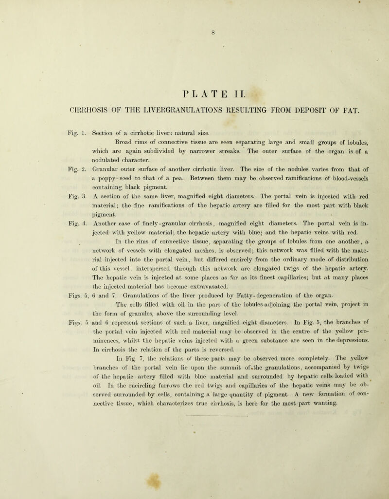 PLATE II. CIRRHOSIS OF THE LIVERGRANULATIONS RESULTING FROM DEPOSIT OF FAT. Fig. 1. Section of a cirrhotic liver: natural size. Broad rims of connective tissue are seen separating large and small groups of lobules, which are again subdivided by narrower streaks. The outer surface of the organ is of a nodulated character. Fig. 2. Granular outer surface of another cirrhotic liver. The size of the nodules varies from that of a poppy-seed to that of a pea. Between them may be observed ramifications of blood-vessels containing black pigment. Fig. 3. A section of the same liver, magnified eight diameters. The portal vein is injected with red material; the fine ramifications of the hepatic artery are filled for the most part with black pigment. Fig. 4. Another case of finely - granular cirrhosis, magnified eight diameters. The portal vein is in- jected with yellow material; the hepatic artery with blue; and the hepatic veins with red. In the rims of connective tissue, .^parating the groups of lobules from one another, a network of vessels with elongated meshes, is observed; this network w.as filled with the mate- rial injected into the portal vein, but differed entirely from the ordinary mode of distribution of this vessel; interspersed through this network are elongated twigs of the hepatic artery. The hepatic vein is injected at some places as far as its finest capillaries; but at many places the injected material has become extravasated. Figs. 5, 6 and 7. Granulations of the liver produced by Fatty - degeneration of the organ. The cells filled with oil in the part of the lobules adjoining the portal vein, project in the form of granules, above the surrounding level. Figs. .5 and 6 represent sections of such a liver, magnified eight diameters. In Fig. 5, the branches of the portal vein injected with red material may be observed in the centre of the yellow pro- minences, whilst the hepatic veins injected with a green substance are seen in the depressions. In cirrhosis the relation of the parts is reversed. In Fig. 7, the relations of these parts may be observed more completely. The yellow branches of the portal vein lie upon the summit of .the granulations, accompanied by twigs of the hepatic artery filled with blue material and surrounded by hepatic cells loaded with oil. In the encircling furrows the red twigs and capillaries of the hepatic veins may be ob- served surrounded by cells, containing a large quantity of pigment. A new formation of con- nective tissue, which characterizes true cirrhosis, is here for the most part wanting.