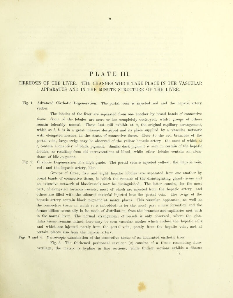 PLATE III CIRRHOSIS OF THE LIVER. THE CHANGES WHICH TAI^E PLACE IN THE VASCULAR APPARATUS AND IN THE MINUTE STRUCTURE OF THE LIVER. Fig. 1. Advanced Cirrhotic Degeneration. Tlie portal vein is injected red and the hepatic artery yellow. The lobules of the liver are separated from one another by broad bands of connective tissue. Some of the lobules are more or less completely destroyed, whilst groups of others remain tolerably normal. These last still exhibit at a, the original capillary arrangement, which at b, 6, is in a great measure destroyed and its place supplied by a vascular network with elongated meshes, in the strata of connective tis.sue. Close to the red branches of the portal vein, large twigs may be observed of the yellow hepatic artery, the most of which at c, contain a quantity of black pigment. Similar dark pigment is seen in certain of the hepatic lobules, as resulting from old extravasations of blood, while other lobules contain an abun- dance of bile - pigment. Fig. 2. Cirrhotic Degeneration of a high grade. The portal vein is injected yellow; the hepatic vein, red; and the hepatic artery, blue. Groups of three, five and eight hepatic lobules are separated from one another by broad bands of connective 'tissue, in which the remains of the disintegrating gland - tis.sue and an extensive network of bloodvessels may be distinguished. The latter consist, for the most part, of elongated tortuous vessels, most of which are injected from the hepatic artery, and others are filled with the coloured material injected into the portal vein. The twigs of the hepatic artery contain black pigment at many places. This vascular apparatus, as well as the connective tissue in which it is imbedded, is for the most part a new formation and the former diffei’S essentially in its mode of distribution, from the branches and capillaries met with in the normal liver. The normal arrangement of vessels is only observed, where the glan- dular tissue remains intact; here may be seen vascular meshes which enclose the hepatic cells and which are injected partly from the portal vein, partly from the hepatic vein, and at certain places also from the hepatic artery. Figs. .3 and 4. Microscopic examination of the connective tissue of an indurated cirrhotic liver. Fig. .3. The thickened peritoneal envelope (a) consists of a tissue resembling fibro- cartilage, the matrix is hyaline in fine sections, while thicker sections exhibit a fibrous 2